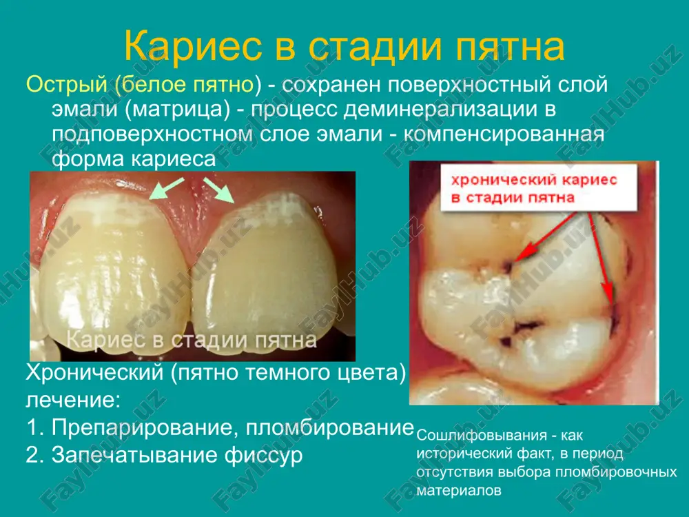 novka patsienta na dispanserniy uchet obshee lechenie mnojestvennogo kariesa - kompleksnoe 1. vliyanie na nespetsificheskuyu rezistentnost organizma: belkovaya dieta (1,5 g / kg), vitamini i mikroelementi 2. medikamentoznaya deystvie nukleinat natriya, orotat kaliya (po 0,5 - 3 raza v sutki), riboksil, pentoksil (po 0,2 - 3 raza v sutki), stimulyatori tsns (eleuterokokk, koren jenshenya, zolotoy koren) 3. vitaminoterapiya: vit.s (0,1-0,2 v den), vit.v6 (0,05-1,0 v den), vit.a (retinol), vit d (ergokaltsifkrol), vit. v2 (tiamin) 4. regulyatsiya soderjaniya mineralnix veshestv: glitserofosfat sa (po 0,5 - 2 r / d v techenie 1 mesyatsa), preparati, soderjashie ftor (4-6 mg v sutki i elektroforez, no krome regionov s povishennim soderjaniem ftora) 5. patogeneticheskaya terapiya: ufo (regioni s malim kolichestvom solnechnix dney) s tselyu profilaktiki 6. fizioterapiya (elektroforez preparatov sa) 7. stimulyatsiya funktsii slyunnix jelez: dieta s povishennim soderjaniem tverdoy, kisloy, pryanoy pishi; trav "derevyannie otvari (termopsis, devyatisila) - 3 r / d po …