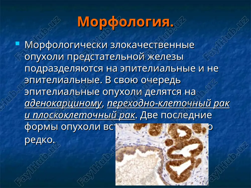 ferentsirovannimi opuxolyami i veroyatnoy prodoljitelnostyu jizni menee 10 let. - stadiya 1b-2b. patsienti bez simptomov s visoko i umerenno differentsirovannimi opuxolyami i veroyatnoy prodoljitelnostyu jizni menee 10 let. patsienti ne dopuskayushie oslojneniy, vizivaemix lechebnimi merami. radikalnaya prostatektomiya vidi: - pozadilonnaya prostatektomiya; -radikalnaya prostatektomiya iz laparoskopicheskogo dostup; - radikalnaya prostatektomiya promejnostnim dostupom). pokazaniya: - stadiya t1a. dlya patsientov molodogo vozrasta s veroyatno dolgoy prodoljitelnostyu jizni, osobenno pri ploxo differentsirovannix opuxolyax. - stadiya 1b-2b. standartnoe lechenie dlya patsientov s veroyatnoy prodoljitelnostyu jizni bolee 10 let, kotorie dopuskayut oslojneniya svyazannie s operatsiey. - stadiya 3a. dlya otdelnix patsientov s veroyatnoy prodoljitelnostyu jizni bolee 10 let. protivopokazaniya: rasprostranenniy rak predstatelniy jelezi, otyagoshenniy somaticheskiy fon, ne pozvolyayushiy vipolnit operativnoe lechenie, ojidaemaya prodoljitelnost jizni menee 10 let. oslojneniya: intraoperatsionnie - krovotechenie, travma pryamoy kishki; rannie posleoperatsionnie - krovotechenie, tela, nesostoyatelnost anastomoza, oim, pozdnie – skleroz sheyki mochevogo puzirya, nederjanie mochi, erektilnaya disfunktsiya. pozadilonnaya prostatektomiya (retrogradnaya i …