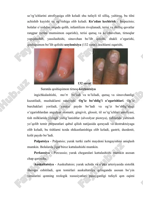 kin kamayganligi ko’zga tashlanib, qonning rang ko’rsatkichi 0,6 (0,85-1,05 normada) gacha va undan ham kam bo’lishi mumkin. qon surtmasida gipoxromiya, mikrotsitoz, anizotsitoz, poykilotsitoz kuzatilib, gipoxromiya bilan mikrotsitozning ifodalanish darajasi kasallikning og’ir kechishidan dalolat beradi. retikulotsitlar soni normaga yaqin bo’lib, qon ketish davrlarida biroz ko’payishi mumkin. trombotsitopeniya kuzatiladi, nisbiy limfotsitoz, monotsitoz, eozinopeniya kuzatilishi mumkin. qon zardobida temirning kamayishi 1,5-2,5 marta va transferinni temir moddasiga toyinishi 15 marta kamayadi. temir saqlovchi fermentlar faolligi pasayishi munosabati bilan me’da va ichaklar shilliq qavatlarida atrofik jarayonlar kechib, axlorgidriya va axiliya ya’ni me’da shirasi ishlab chiqarilishi pasayishi kuzatiladi. instrumental: steril punktsiya; rentgenologik tekshirishda qizilo’ngach, me’da va ichaklar shilliq qavatlari burmachalari atrofiyaga uchrab tekislanadi, bularni gastrofibroskopiya o’tkazganda yana aniqroq ko’rishimiz mumkin. morfologik tekshirish. vitamin b12 va folat tanqis anemiyasi bu kamqonlikda qon hosil bo’ishini buzilishi vitamin b12 yetishmovchiligi natijasida yizaga keladi va giperxrom va megaloblastik tip kamqonlik hisoblanadi (133 a va b surat). a b 133 a …