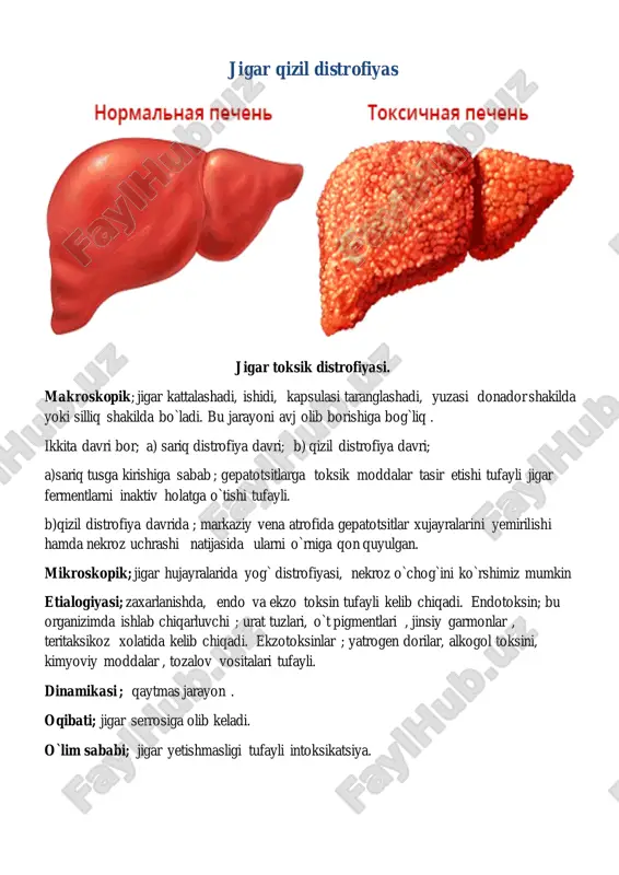 ujayralarida qora rangdagi gemomelanin pigmenti topiladi. kasallik avjida pigmentlarni a’zoning stromasida ham ko’rish mumkin. oqibat: jigarning immunitetdagi rolining susayishi 1 1- qo`ng`ir gemosidirin pigmentini retikulo endotelial tizmda to`planishi ( gepatotsit atrofida) 43-rasm. gemaxramatoz. a- jigarni ko`rnishi ; b- oshqazon osti bezning ko`rnishi ;v- yulduzsimon retikulo endotelositlar va gepatotsitlardagi qo`ng`ir rangli gemosidirin pigment donachalari to`plami ; portal traktlardagi skleroz . gematoksilin va eosin bilan bo`yalgan; g- oshqozon osti bezning atsinar strukturasi epiteliysidagi ko`k – yashil gemosidirin donachalari to`plami. stromaning sklerozi. temirdagi perls riyaksiyasi. gemaxramatozdagi jigar pigmentli serrozi. 1.jigar biriktiruvchi to`qima orqali keng qatlamli bo`laklarga bo`lingan. 2.biriktiruvchi to`qimada gemasidiringa boy makrofaglar to`plami. 3.gepatotsitlardagi mayda gemosidirin . 4, 5 pigmentli serroz birlamchi gemoxromatozdan rivojlanadi, bilamchi gemaxromatoz belgilari; ovqat tarkibida temirni ko`p so`rlishi, genetic suqsonlar, jigarni pigementli serrozi, qandli diabet , kardiomegaliyada shunday kornishga ega bo`ladi. pigmentniy tsirroz pecheni pri gemoxromatoze igar 1 2 3 normal jigar xujayrasi muskat jigar 1- periferiyada saqlanib qolgan …