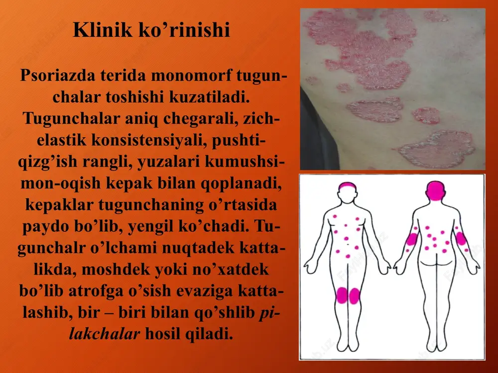 zon osti bezi holati ahamiyatga ega. 2. ayrim hollarda kasallik bevosita tomir (xafaqon) va endokrin(qandli diabet) patologiyalari bilan bog’liq. 3.malum darajada og’iz shilliq qavatining tish patologiyasi tufayli travmizatsiyaga uchrashi sabab bo’ladi. turli xil metallardan tayyorlangan qoplama tishlar so’lak tarkibiga kirib jiddiy tasir etadi, so’lak tarkibida metall zarrachalari kuzatilib, galvanik element toklar hosil bo’ladi. bu holat sabab fermentlar ajralishi sekinlashadi. bu ham kasallik kelib chiqishida malum ahamiyatga ega klinikasi kasallikning asosiy morfologik elementi papulalar bo’lib, uning quyidagi o’ziga xos xususiyatlari bor: 1. poligonal , yassi shaklli 2. papulalar yuzasida (asosan markazida) kindiksimon botiq bo’lishi 3.periferiyaga qarab o’sadi 4. toshmalar ustiga o’simlik moyi surtilsa, to’rsimon shakllar vujudga keladi- uikxem setkasi 5. o’tuvchan yorug’likda toshmalar yuzasining pushti-binafsha rangda yaltirab turishi 6. lunj ichki shilliq qavatida oqish papulalarning paydo bolishi – pospelov – neyman simptomi. uikxem setkasi toshmalarning asosiy joylashadigan sohalari qo’l va oyoq panjalarining yuza qismi, bilakning ichki yuzasi, bilak panja burmasi, tizzaning …