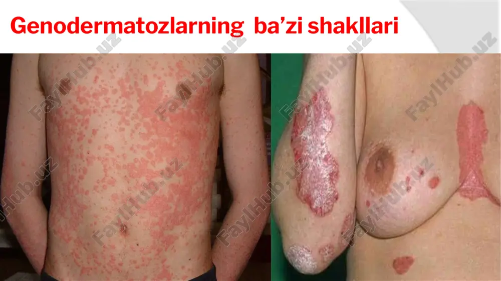 genodermatozlar - Page 5