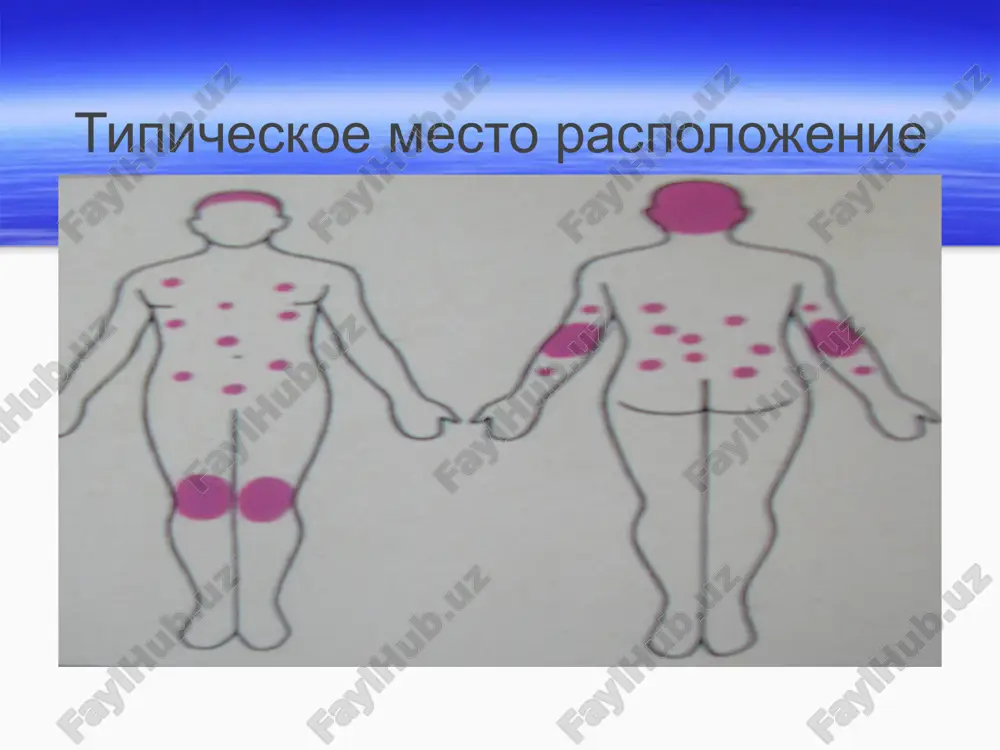 psoriaz xronicheskoe retsidiviruyushee zabolevanie koji, xarakterizuyusheesya visipaniem obilno shelushashixsya papul. prichini vozniknovenie nasledstvenniy vozdeystvie faktorov stressa infektsionnie zabolevanie narushenie obmena veshestv immunologicheskoe izmenenie allergicheskie zabolevanie mikrotravmi klinicheskie vidi tipichniy vulgarniy psoriaz ekssudativniy psoriaz pustulyozniy psoriaz psoriatiknaya eritrodermiya psoriatiknaya artropatiya stadii klinicheskogo techenie progressivnoe (razvivayusheysya) statsionarnoe regressivnoe (utexayusheysya) tipicheskoe mesto raspolojenie psoriaza vulgarniy psoriaz na loktevom sustave bledno-serovatie pyatna pri vulgarnom psoriaze izomorfnaya reaktsiya pri psoriaze vulgarniy psoriaz «naperstka» nogtey pri psoriaze (bulavchatiy priznak) povrejdenie nogtey pri psoriaze regressivnaya stadiya vulgarnogo psoriaza ekssudativniy psoriaz ekssudativniy psoriaz ekssudativniy psoriaz ekssudativniy psoriaz artropaticheskiy psoriaz psoriaticheskaya eritrodermiya pustulyozniy psoriaz pustulyozniy psoriaz prostoy psoriaz: porajenie loktya prostoy psoriaz: bledno-serovatie visipanie. kaplyavidniy psoriaz. razvivaetsya posle angini psoriaz volosistoy chasti golovi. tverdie cheshuyki polnostyu pokrivayut volosistuyu chast golovi. prostoy psoriaz: porajenie tela psoriaz nogtey bulavchatiy vid psoriaz nogtey. patognomonicheskoe jeltoe pyatno na nogtevoy plastinki xarakterno dlya psoriaza psoriaz na kojnix skladkax prostoy psoriaz. porajenie podoshv pustulyozniy psoriaz …