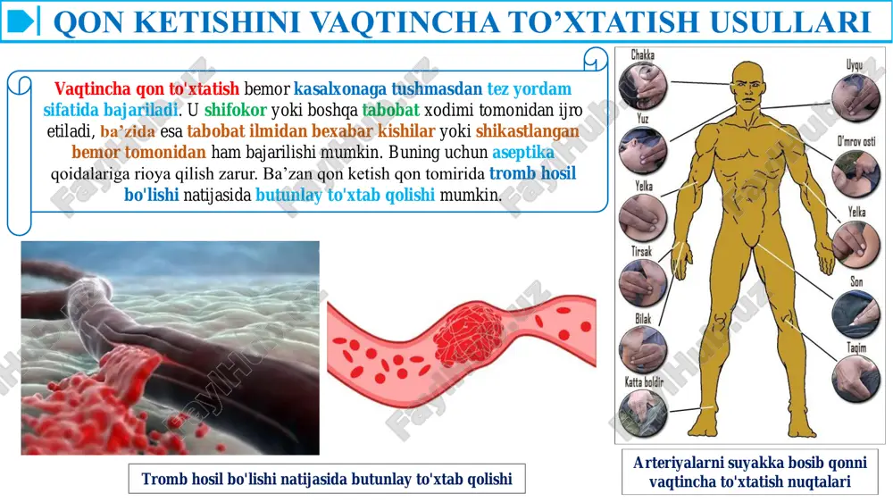 zroq bitishi uchun harorati 60°-70° bo'lgan suv yoki issiq suvga botirilgan tamponlardan foydalanish mumkin (masalan, me'dadan, oshqozondan, qovuqdan qon oqqanda). hozirgi vaqtda sovuqni ma'lum haroratda rejalab beradigan krioapparatlar mavjud. ular parenximatoz, kapillyar qon ketganda keng qo'llaniladi. qon ketishini batamom to'xtatishda hozir lazerlar keng qo'llanilmoqda. qon ketishini to'xtatishning kimyoviy usullari qon ketishini batamom to'xtatishda xirurgik usullarning imkoniyati ko'p bo'lganligi uchun bunda kimyoviy metodlarning ahamiyati ham ortmoqda. hozirgi kunda qonning ivishini oshiradigan moddalardan 10 foizli kalsiy xlorid, kalsiy glyukonat eritmalari, 3 foizli pektin eritmasi va kalsiy xloridning 1 foizli aralashmasi gemofobin, giyohlardan tashkil topgan qon ivishini tezlashtiruvchi moddalar - lagoxilus (krapiva qichitqi o't), bo'y modaron (tisyachelistnik), suv garmdorisi, kalina po'stlog'i eritmalari va boshqalar ishlatiladi. kapillyarlardan qon ketganda, ularning devorini mustahkamlovchi moddalardan 12,5 foiz etamzilat (ditsinon), 0,025 foizli adro ksan ishlatiladi. qonning fibrinolitik faolligi oshganligi natijasida qon ketishi ro'y bergan bo'lsa, shuningdek, o'pka, oshqozon osti va buqoq bezlari, gipoplastik anemiya operatsiyalaridan oldin, yo'ldosh …