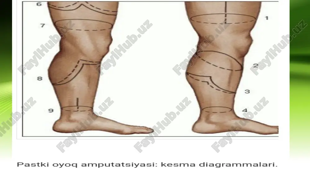 amputatsiya, protezlash ishlari va nogironlar reabilitatsiyasi - Page 5