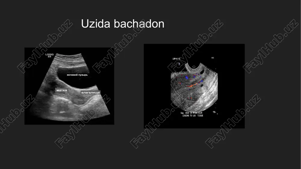 ayollar reproduktiv tizimi a’zolarining nur tashhislash usullari - Page 5