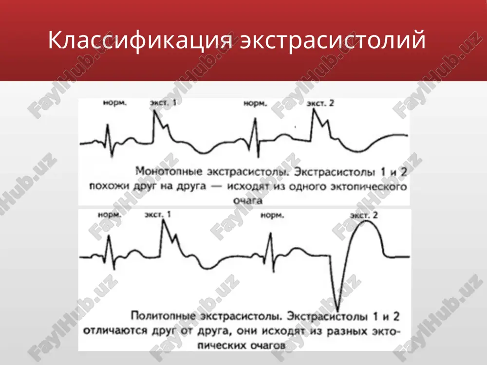 trasistolicheskie). diagnostika ekstrasistoli iz av-soedineniya s odnovremennim vozbujdeniem predserdiy i jeludochkov (a) i bolee rannim vozbujdeniem jeludochkov (b). diagnostika jeludochkovie ekstrasistoli voznikayut pri raspolojenii ektopicheskogo ochaga v provodyashey sisteme jeludochkov. impuls vizivaet prejdevremennoe vozbujdenie jeludochkov i ne rasprostranyaetsya na predserdiya i na sinusoviy uzel, sledovatelno ne proisxodit prejdevremennogo vozbujdeniya predserdiy i razryadki sinusovogo uzla. ocherednoy impuls v sinusovom uzle voznikaet v obichnoe vremya, on vizivaet vozbujdenie predserdiy, no ne rasprostranyaetsya na jeludochki, tak kak oni uje oxvacheni vneocherednim sokrasheniem. vozbujdenie jeludochkov proisxodit neobichnim putem, snachala vozbujdaetsya jeludochek, v kotorom naxoditsya ochag, zatem pozdnee proisxodit vozbujdenie drugogo jeludochka. ekg priznaki jeludochkovix ekstrasistol: prejdevremennoe poyavlenie na ekg izmenennogo kompleksa qrs znachitelnoe rasshirenie (do 0,12 sek. i bolshe) i deformatsiya ekstra­sistolicheskogo kompleksa qrs raspolojenie segmenta rs — t i zubtsa t ekstrasistoli diskordantno napravleniyu osnovnogo zubtsa kompleksa qrs otsutstvie pered jeludochkovoy ekstrasistoloy zubtsa r nalichie posle jeludochkovoy ekstrasistoli polnoy kompensatornoy pauzi elektrokardiogramma pri …