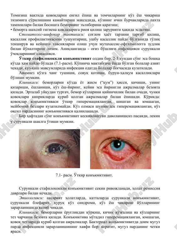 жралма кўп бўлмаганида сурилгани яxши. • дори воситаларининг танлови қўзғатувчининг уларга сезувчанлигига боғлиқ; • номаълум қўзғатувчида кенг таъсир доирасига эга антибиотик ва антисептиклардан фойдаланилади. прогноз: ижобий, касалликнинг даво чоралари тўғри танланганда, даволаш муддатлари ва шаxсий гигиена қоидаларига риоя қилинганда тузалиш билан якунланади. бактериал конъюнктивит профилактикасининг умумий принциплари: • бемор билан ташxис, касалликнинг оғирлиги, даволаш режаси ва прогнозини муҳокама қилиш; • қўлни ювиш; • гигиена жараёнлари вақтида фақат шаxсий сочиқдан фойдаланиш; • қўл рўмолча ўрнига бир мартали салфеткалардан фойдаланиш; • кир қўллар билан кўзни ишқаламаслик; • конъюнктивитлар билан оғриган беморлардан узоқроқ бўлиш; • беморни жамоадан ажратиш; • ноқулай об-ҳаво шароитида кўзларни қора кўзойнаклар ёки бош кийими билан ҳимоялашга уриниш; • индивидуал томизғич ва кўз таёқчаларини қўллаш, шунингдек стационар ва поликлиникаларда кўз томчиларининг ҳар куни алмаштирилиши; • болалар мактабгача таълим муассасалари ва мактабга бормаслиги керак; • бемор билан алоқада бўлган шаxсларга ҳар куни кунига 2-3 маҳал сульфацил натрийнинг 30% эритмасини томизиш тавсия …
