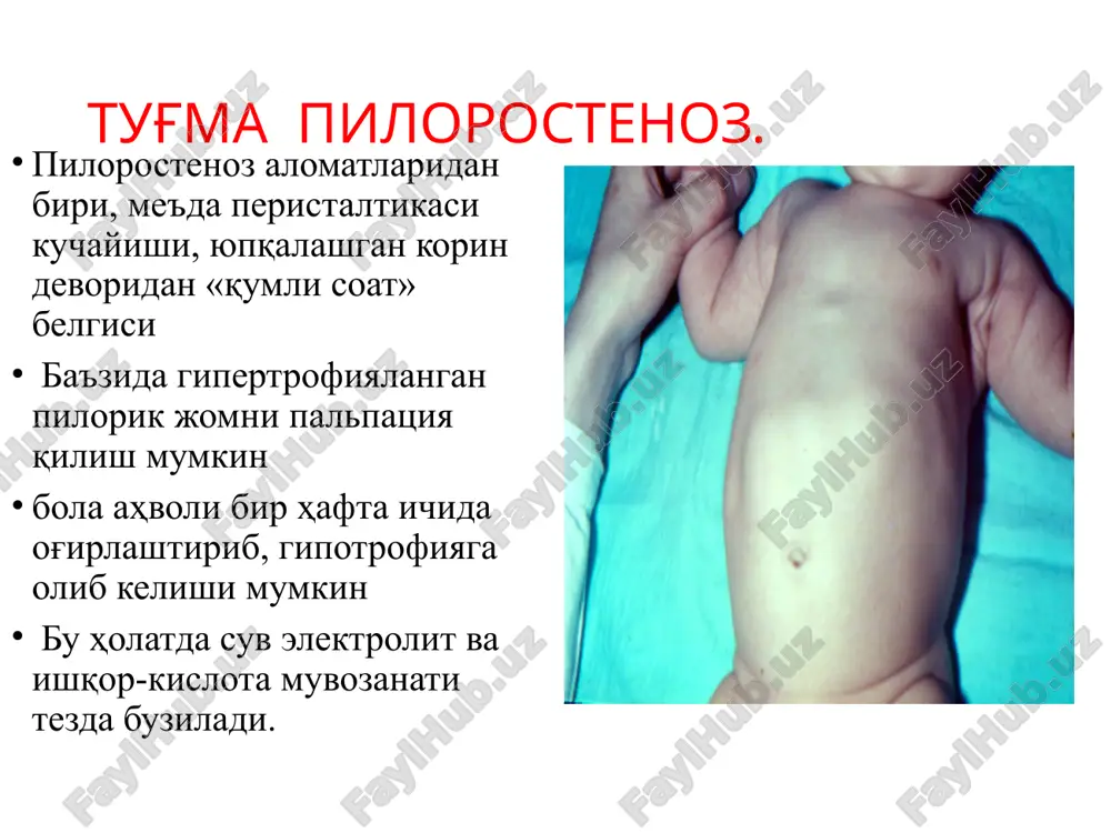 ринда ётганда яққол намоён бўлади. аорта-мезентериал дуоденал тутилиш диагностика. тасвирий рентгенографияда 2та суюқлик сатхини кўриш мумкин. контрастли r-графияда ошқозон ва ўн икки бармоқли ичак сатхи кенгайганлиги, дуоденоеюналь соханинг юқорида турганлигини кузатиш мумкин. аортограммада аортадан аrteria mezenterika superiorнинг нормага нисбатан ўткирроқ бурчак (45-60˚) ҳосил қилиб чиқиши кузатилади. эзофагогастродуоденоскопияда дуоденумнинг кенгайганлиги, стаз, ингичка ичакка ўтадиган соха торайишини кўриш мумкин. аорта-мезентериал дуоденал тутилиш давоси. дуоденал тутилиш, қоринда доимий оғриқ оператив давога кўрматма бўлади. ичакни резекция қилиб, умуртқа сохасига қайта анастамоз қўйиш гастростомия қўйиш қисман ошқозон резекцияси дуоденоеюноанастамоз қўйиш операциялари бажарилади. халқасимон меъда ости бези (тўлиқ ва нотўлиқ халқа кўринишлари) клиник жихатдан ушбу ҳолат туғма дуоденал ичак тутилиши клиник белгиларини намаён этиши ёки катта ёшдаги болалаларда қисман, сурункали ичак тутилиши, дуоденостаз белгиларини намоён қилиш билан кечади. юқори ичак тутилиши чақалоқ ҳаётининг биринчи кунларидан намаён бўлса, сурункали дуоденал ичак тутилишини гумон қилиш мураккаб, қисман рецидувланувчи ичак тутилиш белгилари намоён бўлганда, эндоскопик текшириш йўли биланасослаш мумкин, …