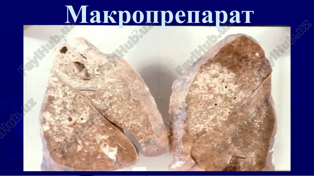 ўпканинг кавернали, фиброз-кавернали ва цирротик туберкулези - Page 5