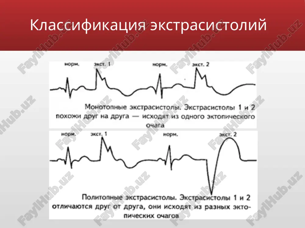ков. импульс вызывает преждевременное возбуждение желудочков и не распространяется на предсердия и на синусовый узел, следовательно не происходит преждевременного возбуждения предсердий и разрядки синусового узла. очередной импульс в синусовом узле возникает в обычное время, он вызывает возбуждение предсердий, но не распространяется на желудочки, так как они уже охвачены внеочередным сокращением. возбуждение желудочков происходит необычным путем, сначала возбуждается желудочек, в котором находится очаг, затем позднее происходит возбуждение другого желудочка. экг признаки желудочковых экстрасистол: преждевременное появление на экг измененного комплекса qrs значительное расширение (до 0,12 сек. и больше) и деформация экстра­систолического комплекса qrs расположение сегмента rs — т и зубца т экстрасистолы дискордантно направлению основного зубца комплекса qrs отсутствие перед желудочковой экстрасистолой зубца р наличие после желудочковой экстрасистолы полной компенсаторной паузы электрокардиограмма при разных формах желудочковой экстрасистолии электрокардиограмма при разных формах желудочковой экстрасистолии а — монотопная желудочковая экстрасистолия, экстрасистолические комплексы появляются преждевременно, резко отличаются по форме от желудочковых комплексов основного синусового ритма, …