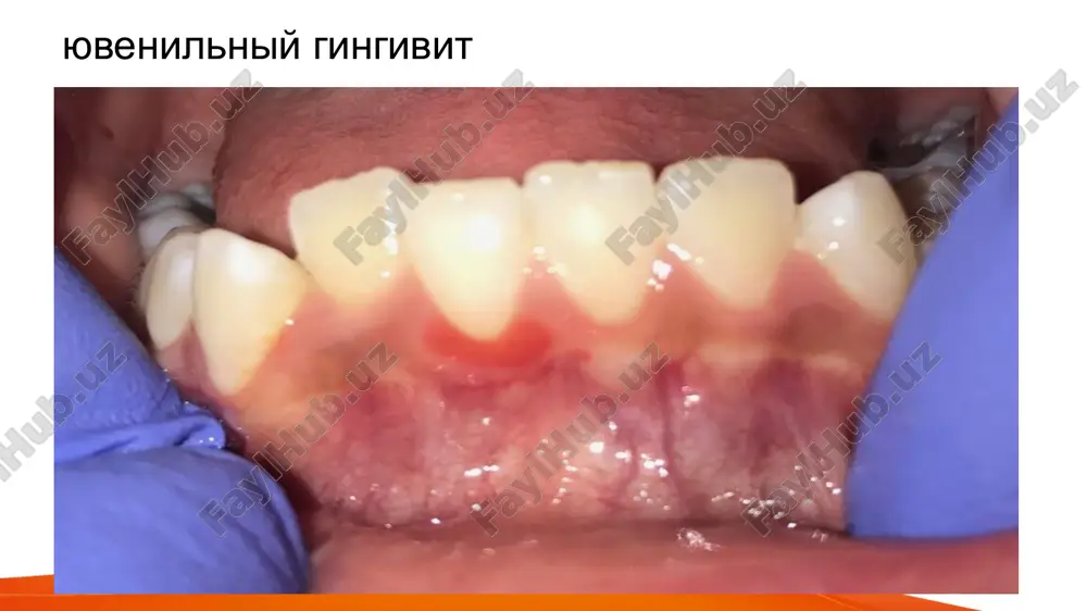 yuvenil gingivit kechishi va uni davolash - Page 5