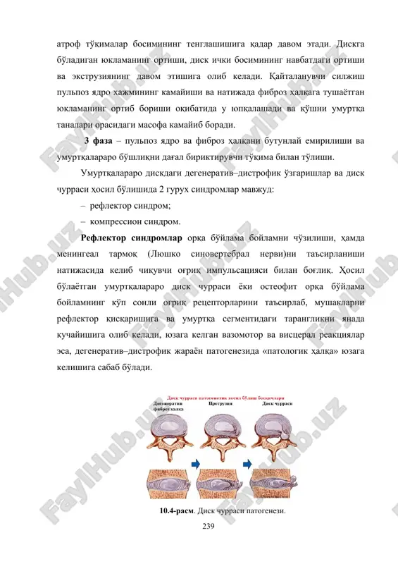 ining buzilishi bilan kechuvchi disk qismini umurtqa kanaliga tushishi. orqa miya va uning ildizlarini bevosita ezilishi. 4. diskda erkin sekvestrlangan bo'laklarni hosil bo'lishi. disk moddasi umurtqa kanalida joylashadi. o'tkir holatlarda yoki jaroxat natijasida miya qattiq pardasi yirtilishi va churra massasini intradural joylashishi kuzatilishi mumkin. 10.6-rasm. disk churrasi bosqichma-bosqich rivojlanishi. aksariyat hollarda, kompressiya chaqiruvchi omillar (disk churrasi, osteofitlar)ni aksial tekislikda joylashishi bo'yicha tasnifi tan olinadi. bu tasnifga ko'ra kompressiya omillarni quyidagi turlari farq qilinadi: 1. o'rta, sagittal o'qqa nisbatan markazda joylashishi. 2. paramedian, sagittal tekislikka nisbatan lateral joylashishi. 3. chetki, umurtqa ravog'i sohasida joylashishi. 4. foraminal, umurtqalararo teshikka kirib borishi. bundan tashqari, umurtqa pog'ona osteoxondrozi tasnifi n.s.kosinskaya bo'yicha umurtqa pog'onsida yuklamaning vertikal yo'nalishda taqsimlanishi mavjud (10.7-rasm ): – vertikal yuklama taqsimlanishi; – boshlang'ich o'zgarishlar; – rivojlangan osteoxondroz; – kuchli rivojlangan osteoxondroz. 10.7-rasm. umurtqa pog'onsida yuklamaning vertikal yo'nalishda taqsimlanishi. a– vertikal yuklama taqsimlanishi. b–boshlang'ich o'zgarishlar. v–rivojlangan osteoxondroz. g– kuchli rivojlangan osteoxondroz. 10.8-rasm. …
