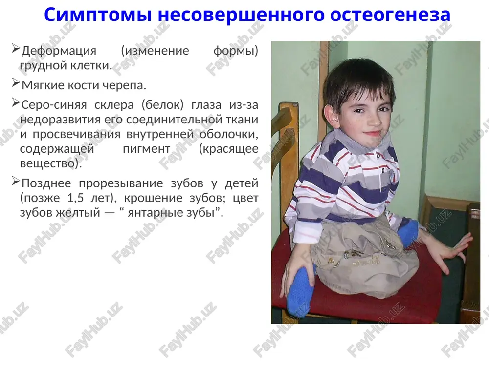 ya utrata sluxa (tugouxost). rannee vipadenie zubov. chastie pnevmonii (vospalenie legkix) iz-za deformatsii grudnoy kletki. profilaktika nesovershennogo osteogeneza nalichie bolnix v rodoslovnoy yavlyaetsya pryamim pokazaniem k mediko-geneticheskomu konsultirovaniyu. spasibo za vnimanie! normal osteogenesis imperfecta cortical | width | __ trabecular compartment g @ g é i q@ g g q \ kosteoblast y osteoid osteoclast collagen deposited in extracellular matrix and modified for strengthening collagen collagen packaged for packaged for secretion secretion mutated collagen transferred to collagen trans- “ golgi ferred to golgi mutated chains synthesized, modified, and abnormal trimer forms chains synthesized) modified, and orr. reticulum dna coding for dna coding for’ defective collagen ' eras collagen chains chains nucleus : 7 endoplasmic’ reticulum marc e. tischler, phd normal cell dept of chemistry & mutated cell biochemistry univ of arizona » quantitative defects of type 1 collagen : mutations semen on col1a gene, production of premature stop codon or …
