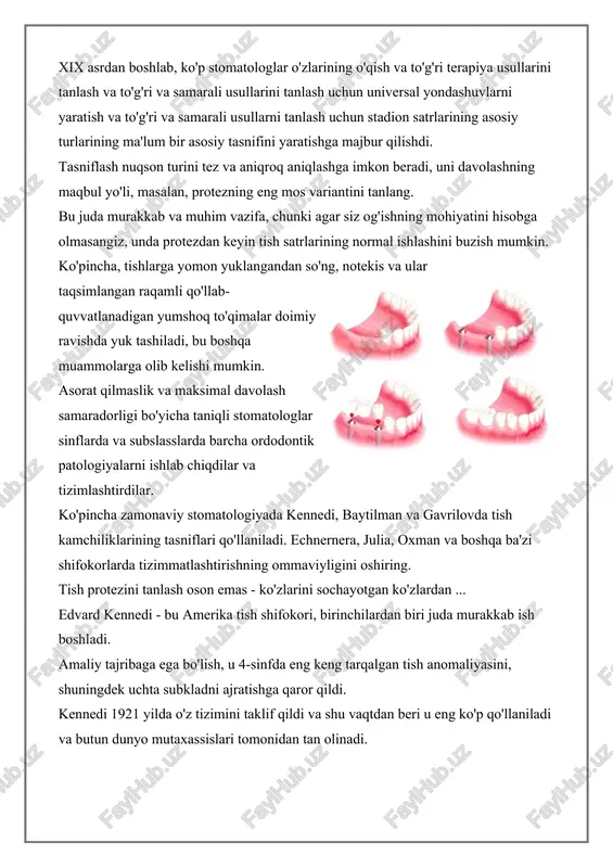 d: · nafaqat tish satrining yon tomonlarida, balki boshqa joylarda tishlarning etishmasligi; · 2-o'rinda ba'zi tishlarning etishmasligi (yon tomonlarni hisobga olmang); · barcha 3 o'rindiqning etishmasligi, asosiy yon chaynashdan tashqari. birinchi guruh normaidan o'tishni davolash uchun predlezning asosiy varianti - bu buzilgan tishlarni o'rnatish uchun maxsus asboblarni yaratadigan maxsus moslamalar mavjud bo'lib, ular shikastlangan tish qatoriga qo'shilishi kerak. kennedi ikkinchi klassi distal qo'llab-quvvatlashning yo'qolishi bilan bir tomonlama nuqsonning mavjudligini o'z ichiga oladi. bu erda subklass avvalgi versiyada bo'lgani kabi: 1-chi, asosiy nuqsonning mavjudligini, 2-chi, 3-chi - uchtasiga qo'shimcha ravishda yo'qolgan tishni nazarda tutadi. tuzatishning eng yaxshi usuli - bu salomatlik tishlardan pirakal mahkamlash bilan, shuningdek, nuqson to'g'ridan-to'g'ri burchakning yon tomondan mahkamlash. uchinchi sinf bir tomonlama buzilishni o'z ichiga oladi, ammo distal qo'llab-quvvatlash mavjud. subclasslarning barchasi avvalgi versiyalardagi kabi bir xil. davolash uchun eng yaxshi dizayn - bu ma'lumotdan foydalangan holda maxsus olinadigan dizayn. to'rtinchi sinfda tishlarning old qismida joylashgan oldingi …