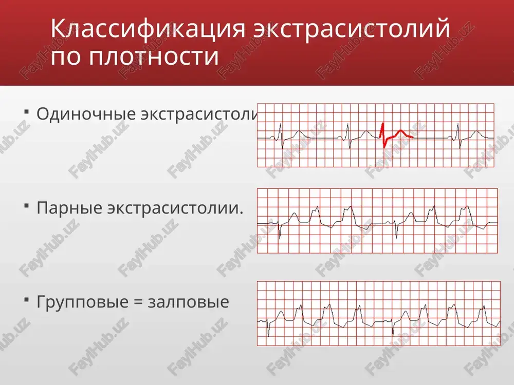 vim kompleksam (vklyuchaya ekstrasistolicheskie). diagnostika ekstrasistoli iz av-soedineniya s odnovremennim vozbujdeniem predserdiy i jeludochkov (a) i bolee rannim vozbujdeniem jeludochkov (b). diagnostika jeludochkovie ekstrasistoli voznikayut pri raspolojenii ektopicheskogo ochaga v provodyashey sisteme jeludochkov. impuls vizivaet prejdevremennoe vozbujdenie jeludochkov i ne rasprostranyaetsya na predserdiya i na sinusoviy uzel, sledovatelno ne proisxodit prejdevremennogo vozbujdeniya predserdiy i razryadki sinusovogo uzla. ocherednoy impuls v sinusovom uzle voznikaet v obichnoe vremya, on vizivaet vozbujdenie predserdiy, no ne rasprostranyaetsya na jeludochki, tak kak oni uje oxvacheni vneocherednim sokrasheniem. vozbujdenie jeludochkov proisxodit neobichnim putem, snachala vozbujdaetsya jeludochek, v kotorom naxoditsya ochag, zatem pozdnee proisxodit vozbujdenie drugogo jeludochka. ekg priznaki jeludochkovix ekstrasistol: prejdevremennoe poyavlenie na ekg izmenennogo kompleksa qrs znachitelnoe rasshirenie (do 0,12 sek. i bolshe) i deformatsiya ekstra­sistolicheskogo kompleksa qrs raspolojenie segmenta rs — t i zubtsa t ekstrasistoli diskordantno napravleniyu osnovnogo zubtsa kompleksa qrs otsutstvie pered jeludochkovoy ekstrasistoloy zubtsa r nalichie posle jeludochkovoy ekstrasistoli polnoy kompensatornoy …
