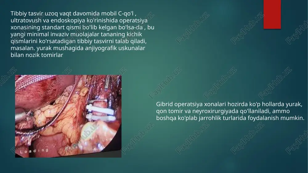 svirlash tizimini tanlashga qarab, uskunani nazorat qilish xonasini o'z ichiga olgan holda, texnik va tayyorgarlik xonalari bundan mustasno, 70 kvadrat metrlik xonaga ega bo'lish tavsiya etiladi. bundan tashqari, tibbiy tasvirlash tizimi tomonidan chiqariladigan radiatsiyadan himoya qilish uchun 2-3 mm qalinlikdagi qo'rg'oshin qalqoni o'rnatilishini ta'minlash kerak. bundan tashqari, tanlangan tibbiy tasvirlash tizimiga qarab, tibbiy tasvirlash tizimining qo'shimcha og'irligini qo'llab-quvvatlash uchun zamin yoki ship tuzilishini mustahkamlash kerak bo'lishi mumkin. (taxminan vazni 650-1800 kg) operatsiya xonasida ish jarayoni tahrirlash gibrid operatsiya xonasini rejalashtirish ko'plab tomonlarning ishtirokini talab qiladi. operatsiya xonasida silliq ish jarayonini ta'minlash uchun operatsiya xonasida ishlaydigan barcha tomonlar o'z vazifalarini bajarish qobiliyatini ta'minlash uchun o'z talablarini o'z vaqtida belgilashlari kerak. bu talablar fazo, tibbiy va tasvirlash uskunalari kabi parametrlar orqali xonaning yakuniy dizayniga ta'sir qiladi . shu sababli, samarali gibrid operatsiya xonasini rejalashtirish professional loyiha menejerini jalb qilishni talab qiladi. bundan tashqari, rejalashtirish bir necha takrorlashda sodir bo'lishi mumkin. iteratsiyalar bizga …