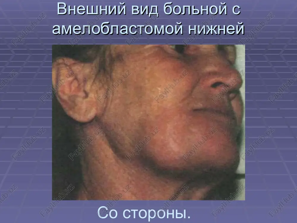 ameloblastoma - Page 5
