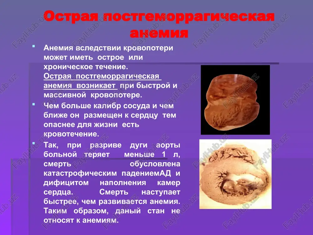 min v-12- folievodifitsitnaya (pernitsioznaya) anemiya gipoplasticheskie i aplasticheskie anemii anemii, kotorie voznikayut vsledstvii glubokogo ugneteniya protsessov krovetvoreniya kak endogennimi tak i ekzogennimi faktorami. eti faktori vedut k potere sposobnosti kostno-mozgovix kletok k regeneratsii. v rezultate kostniy mozg ploskix kostey zameshaetsya jirovoy tkanyu ( “chaxotka” kostnogo mozga) – panmieloftiz kostniy mozg pri gipoplasticheskoy anemii panmієloftіzm.jpg gipoplasticheskie anemii obuslovleni ekzogennimi faktorami a) luchevaya anemiya; b) toksicheskie veshestva (toksicheskaya benzolnaya anemiya); v) medikamentoznaya anemiya prodoljitelnoe ispolzovanie antibiotikov shirokogo spektra deystviya dlya kotorix xarakterno povrejdenie krovetvornix kletok - prodoljitelnoe ispolzovanie sedativnix preparatov (narushenie neyro-gumoralnoy regulyatsii krovetvoreniya) - prodoljitelnoe ispolzovanie preparatov gruppi paratsitamola( toksicheskoe deystvie na krasniy kostniy mozg) g) zamena normalnoy krovetvornoy tkani drugoy (metastazi opuxoley, zameshenie kostnoy tkanyu(osteoskleroz) – osteoskleroticheskaya anemiya) gemoglobinopatii (gemoglobinozi). gemoglobinopatii (gemoglobinozi). v osnove lejit naru­shenie sinteza gemoglobina. lee i cooly (1925) opisali talassemiyu, v osnove kotoroy lejit narushenie sinteza odnoy iz belkovix tsepey gemoglobina. dlya nee xarakteren autosomno-dominantniy put …
