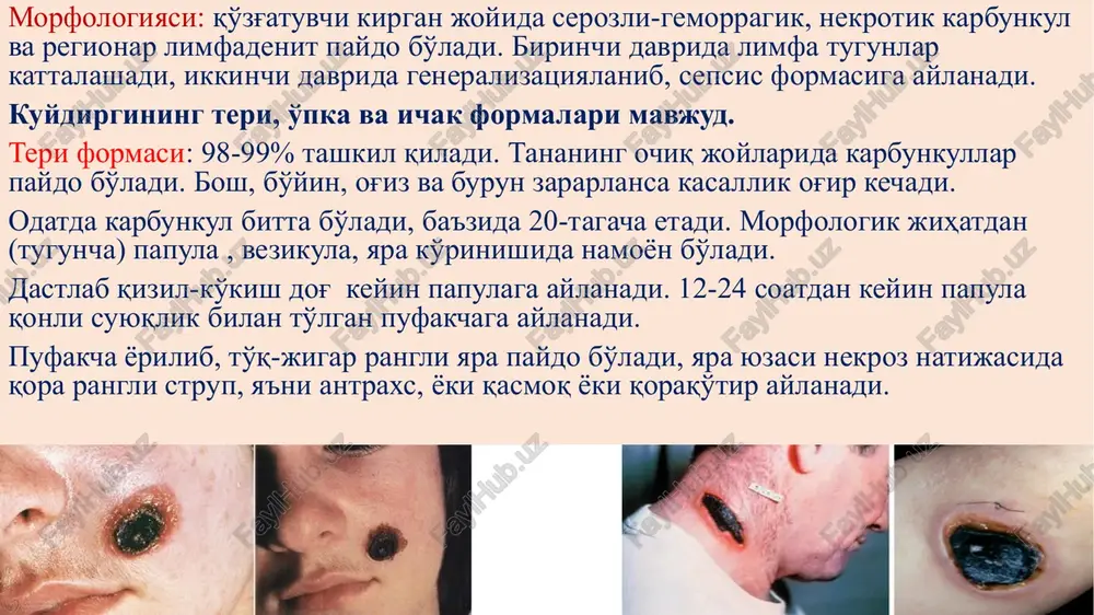 gemorragik isitma(gemorragicheskaya lixoratka) - Page 5