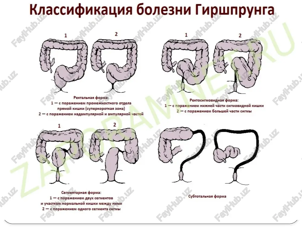 cermentos cygrotanshas dopma mi yuactkom hopmanbhoh khuikm mekay han 2 — cnopamennem ophoro cermenra curmet ? puc, 1. cxemarnueenoe 120gpaxenne ocwosmnix anarommueckitx ops gores tippy 1 — pexranitan cbopaa: a ~ € nopaxchhen npomextocthoro ornea nipamoft kisunkh (eynepkopot- kas 90a), 6 —€ mopaxkcrnem haxasmyaaphol it amnyaaphort tacrelts ht — pextocursonanies bopsta: a — © nopaxehiew h/3 emrmoninuion khwki, 6 — € nopakehiest sostuuest wacri curbs; hie — cermentapnaa dbopwma: a — ¢ nopaxenmest abyx cermtehtton #1 yactkom hopmanbhtof kinikh mey muna, 6 — ¢ nopaxeniiem oxoro cermentta chem: iv ~ cygroranonaa opsta qranbi onepaynuh soave — chiowmikhha jk ahomasiun b3qaumopacnoomkehua |. atpe3na npanda! riis co cbuliom bo brlaranuue. 2. atpe3van mpamom kuluky co cbuliom b moluohky. 3. atpe3ua nmpamon kulwiky co cbulliom b npome@xkhoctb = ss 2 @ a fa) tpabha chctema 1 [ - epodscenuti miukoeudhuti ecepn uky oucmabhozo bidpi3ka kay60eo! kuuku, cnocmepizaemocay 2-3% s1odelti. ‘aiweptnnyn mekxena www.anatom.ua /docprops/thumbnail.jpeg …