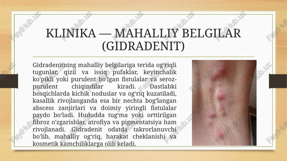 tyunistik qoʻllanilishi hamda bemorni tergov va rehabilitatsiya qilish tavsiya etiladi. shuningdek, murakkab yoki takrorlanuvchi holatlarda mutaxassislar (dermatolog, proktolog, umumjarroh) bilan maslahatlashish zarur. e'tiboringiz uchun rahmat! image5.png image6.png image7.png image8.png image9.png image3.png image4.png /docprops/thumbnail.jpeg gideadenit, mast, paraproktt, masally va bn sy lnk belglavins ‘obyeltivaniglash, davolash prinsipls