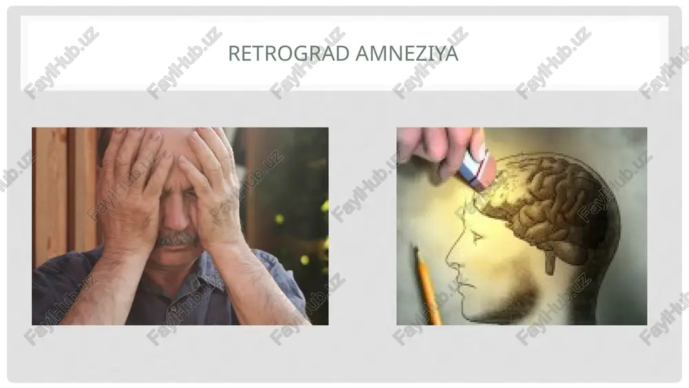 i va korinning tumtok shikasti bulgan bemorning kurinishi 29 parenximatoz a'zolar shikastlanganda: 1. ichki kon ketishi va utkir anemiya belgilari. 2. korin bushligi yon kanallarida tumtok tovush eshitilishi. 3. peritoneal belgilar paydo bulishi. 30 korinning tumtok shikastida jigarning yorilishi, ichki kon ketishi 31 davolash korin bushligi a'zolari shikastlangan bemorlarni shoshilinch ravishda operativ davolash zarur. bushlikli a'zolar shikastlanganida ularga choklar kuyiladi yoki rezektsiya kilinib, korin bushligi sanatsiya kilinadi va drenaj naychalar urnatiladi. jigar shikastlanganida esa unga choklar kuyiladi yoki katta charvi bilan tamponada kilinadi. talok shikastlanib ichki kon ketishi kuzatilganida esa splenektomiya kilinadi. 32 buyraklar shikastlanib kon ketish bilan asoratlanganida buyrak jaroxatiga choklar kuyiladi. bundan samara bulmagan xolatlarda esa nefrektomiya kilinadi. siydik pufagi shikastlangan bulsa choklar kuyilib, siydik pufagiga kateter urnatiladi yoki epitsistostoma kuyiladi. 33 e'tobiringiz uchun rahmat image2.jpeg image3.jpeg image4.jpeg image5.jpeg image6.png image7.jpeg image8.jpeg image9.jpeg image10.jpeg image11.jpeg image12.jpeg image13.jpeg image14.jpeg image15.png image16.jpeg image17.jpeg image18.jpeg image19.jpeg image20.jpeg image21.jpeg image22.jpeg image23.jpeg image24.jpeg …
