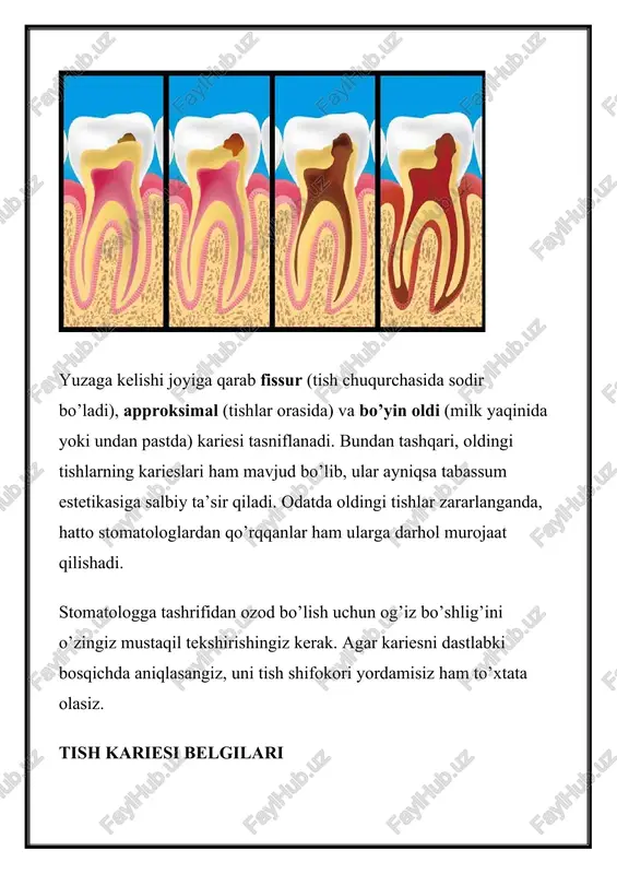 ni davolashda, odatda, stomatologga ikki marta tashrif buyurish kerak bo’ladi — birinchi marta vaqtinchalik plomba, so’ngra esa doimiy plomba qo’yiladi. agar karies plomba ostida paydo bo’lsa, uni aniqlash uchun rentgenografiya qo’llaniladi. kariyeslarni davolashning ikkita asosiy usuli mavjud: noinvaziv («arralashsiz») va invaziv (ta’sirlangan to’qimalarni arralab tashlash bilan). usulni tanlash kasallikning bosqichiga bog’liq. arralashsiz konservativ davolash ushbu davolashda arralash qo’llanilmaydi. ushbu usul, agar kasallik dastlabki bosqichda bo’lsa, ya’ni emalning rangi o’zgargan bo’lsa yoki bemor organizmining xususiyatlari (masalan, og’riqsizlantiruvchi preparatlarga allergik reaktsiya) mavjud hollarda qo’llaniladi. noinvaziv usulning mohiyati emalning yumshoq karashi va minerallanishini olib tashlashdir. davolash bir necha bosqichlarda amalga oshiriladi: tekshirish, milkdan ajratish va zarur materiallarni qo’llash. jarayonning davomiyligi taxminan bir soatcha bo’ladi, bu jihozlarga va stomatolog malakasiga bog’liq. agar davolanish sifatli amalga oshirilsa, kasallik tishlar to’g’ri parvarish qilinganda qaytalanmaydi. biroq, bemor yana o’z yomon odatlaridan voz kechmasa, bu yerda shifokorning aybi bo’lmaydi. tishning qattiq to’qimalarini arralash bilan davolanish tishning zararlangan qismlariga …