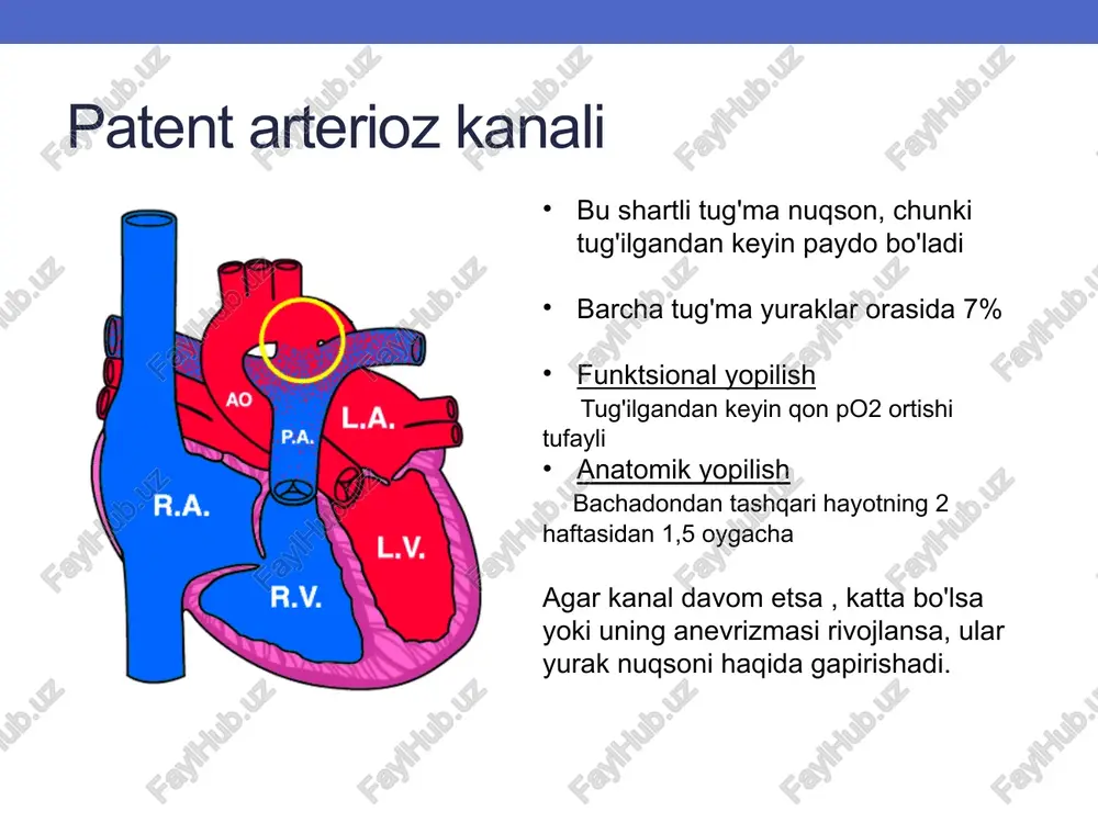shaklidagi yurak katta tomirlarning transpozitsiyasi kritik kanalga bog'liq nuqson aorta o'ng qorinchadan chiqadi va a'zolar va to'qimalarni venoz qon bilan ta'minlaydi , o'pka magistrali esa chap qorinchadan chiqadi va kislorodli qon faqat o'pka qon aylanishida aylanadi. buzilmagan interventrikulyar tms bo'lim buzilmagan interventrikulyar tms va lv chiqish yo'lining torayishi - vsd bilan tms - vsd bilan tms va rozetkaning torayishi lv bo'limi o'ng qorincha chap qorincha aorta o'pka tanasi tizimli qon aylanishi o'pka qon aylanishi venoz qon arterial qon ikkita aloqa bo'lmagan aylanish doiralari patent arterioz kanali, patent teshigi, vsd, asd mavjudligini talab qiladi. arterial gipoksemiya yurak etishmovchiligi auskultativ tovushlar siyanoz nafas qisilishi taxikardiya kardiyomegali o'pkada nam xirillashlar faqat pda, vsd yoki o'pka stenozi mavjudligida eshitiladi diagnostika: - echo-kg qorinchalar va chiqish yo'llarining morfologiyasini vizualizatsiya qilish qo'shimcha aloqalarni baholash (pda, asd, vsd) - ko'krak qafasi rentgenogrammasi o'pka naqshini mustahkamlash kardiyomegali chap koronar arteriyaning anomal kelib chiqishi o'pka magistralidan lca orqali chap …
