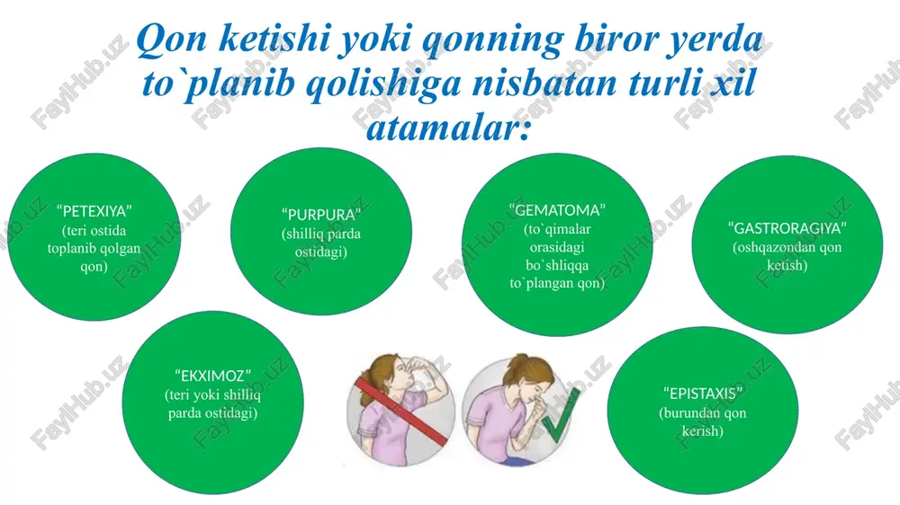 ish yoki o'ta cho'zish \ => taqim arteriyasi yaralanganda tizza bogimini, yelka arteriyasi yo / shikastlanganda tirsak bo'g'imini, son arteriyasi yaralansa, chov sohasida chanog-son bo'g'imini maksimal bukish yaxshi yordam berishi mumkin t/uploads/si qon ketishni vaqtincha tuxtatish usullari | toshkent tibbiyot akademiyasining umumiy va bolalar xirurgiyas! kafedrasi 20:03 12.03.2018 © @) bl ene g qonketish - moncks go x € > c(o webtmauz/aps #2 cepeuces [} asvagvnersr §] anaenc @) virepner [b mailru gy moncks vnrepwere g seenonscreen nev g marsumeiexeryue oxunova.o. qon ketayotgan joydan yuqorisiga jgut yoki boshqa biror bog'lam qo'yish => qattiq tortilgan jgut yoki bog'lam to‘qimali bu- rama tomimi suyakka qisib turadi. jgutni birinchi marta 1873-yilda esmarx ish- latgan, ammo bu usul xvi asrlarda aleksandri- yada ambruaz pare tomonidan taklif qilinib, keyinchalik yoddan ko'tarilib ketgan. ~ ambruaz pare fridrix fon esmarx savollardan javoblarga, shubxalardan dadillikka, ishqibozlikdan professionallikka ow banc , g aon ketish movers go x / ty …