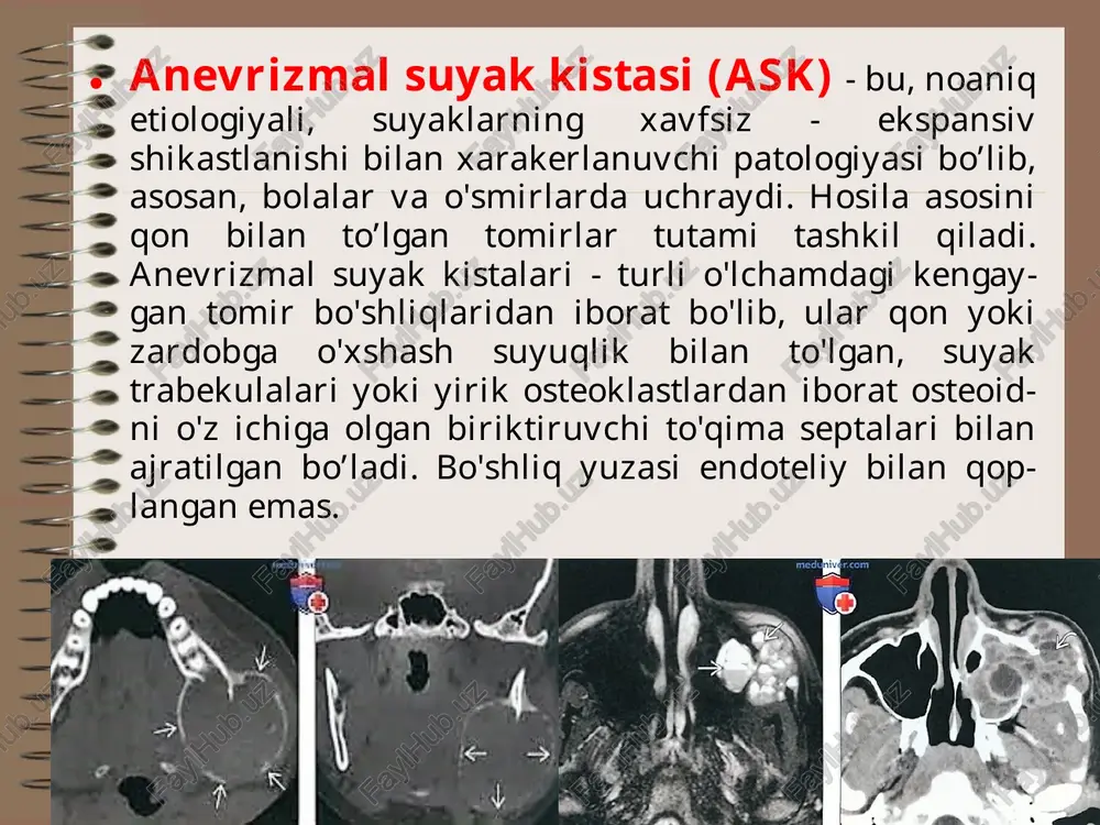 ‘smalar. yuz-jag‘ soxasining orgononospetsifik epitelial o‘smalari № orgononospetsifik xavfsiz epitelial o‘smalar. 1 papilloma 2 keratoakantoma 3 adenoma orgononospetsifik xavfli epitelial o‘smalar. 1 rak -yassi hujayrali (muguzlanuvchan, muguzlanmaydigan) -adenokarsimoma papilloma keratoakantoma - teridan rivojlanuvchi, tez osuvchi xavfsiz hosila. yassi hujayrali (muguzlanuvchan, muguzlanmaydigan) raklar. yuz – jag’ soxasining organonospesifik o’smalari. № melanin hosil qiluvchi to’qima o’smalari. № nerv to’qimasi o’smalari 1 nevuslar 1 nevrinoma -chegaradagi -intradermal -murakkab, aralash -galonevus -epitelioidli -balon hosil qiluvchi hujayralar nevusi -gigant pigmentli nevus -involyusion nevus -havorang nevus shvannoma. neyrofibroma. - reklenxauzen kasalligi melanin hosil qiluvchi to’qima xavfli o’smalari. 1 melanoma chegaradagi nevus. intradermal nevus aralash (murakkab) nevus. galonevus epitlioidhujayrali nevus. ballon xosil kiluvchi xujayralar nevusi moviy nevus melanoma shvannoma neyrofibroma - asab to'qimalarining qo'llab-quvvatlovchi hujayrala- ridan (schwann hujayralari) va tananing biriktiruvchi to'qima hujay- ralarida (fibroblastlar) rivojlanadigan periferik asabning yaxshi sifatlii o'smasi. neyrofibromatoz (reklenxauzen kasalligi)- bu inson tanasida ko'plab o'sma hosilalari ko’rinishida paydo bo'lgan genetik kasallik. ko'pincha xavfsiz …