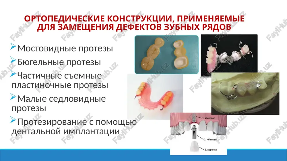 vnoe prostranstvo, vid kotorogo zavisit ot topografii defekta. v oblasti jevatelnix zubov promejutochnuyu chast, kak pravilo, delayut visyachey, a v oblasti perednego otdela chelyusti — kasatelnoy. pri kasatelnoy forme - konchik zonda legko vvoditsya pod telo proteza, znachit, davlenie na desnu otsutstvuet i v to je vremya net vidimoy sheli, kotoraya viglyadit neestetichno pri ulibke ili razgovore. pri visyachey (promivnoy) forme – osnovanie zonda vvoditsya mejdu slizistoy i telom, chto obespechit xoroshiy gigienicheskiy uxod. sedloobraznaya forma tela mostovidnogo proteza protivopokazana, tak kak vozmojno vozniknovenie glubokix prolejney. etu formu primenyayut v s'emnix mostovidnix protezax, tak kak poslednie snimayutsya i legko ochistyatsya, v nekotorix sluchayax v metallokeramicheskix. neobxodimim trebovaniem pri preparirovanii opornix zubov pod mostovidniy protez yavlyaetsya pridanie parallelnosti stenkam opornix zubov. kliniko-laboratornie etapi izgotovleniya shtampovano-payannogo mostovidnogo proteza 1)klinich. etap - preparirovanie opornix zubov pod shtampovannie metallicheskie koronki i snyatie slepkov (polnogo anatomicheskogo s proteziruemoy chelyusti — rabochego i vspomogatelnogo s protivopolojnoy …