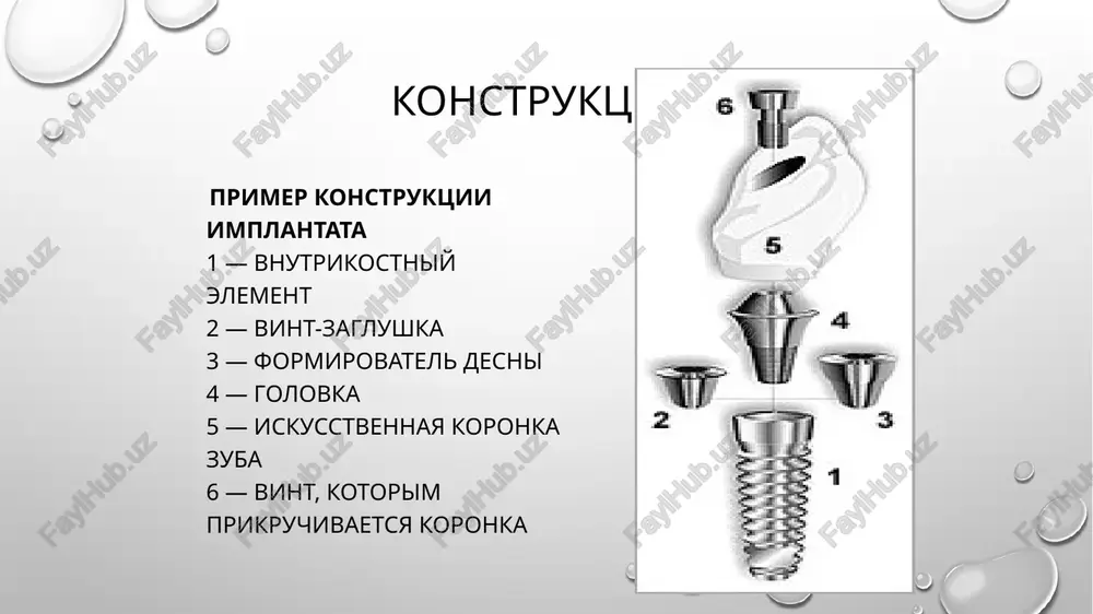 ojeni abatmenti ili vinti, mejdu soboy oni soedineni metallicheskoy balkoy; sam s'emniy protez sostoit iz osnovi, kotoraya igraet rol desnevoy tkani, a takje zubnix koronok; vnutri s'emnogo proteza naxoditsya metallicheskoe kreplenie, kotoroe nadevaetsya na balku, soedinyayushuyu abatmenti. kakie bivayut vidi implantatsiy zubov protsedura implantatsii bivaet: odnoetapnoy dvuxetapnoy neposredstvennoy otsrochennoy. odnoetapnaya metodika implantatsii. eta metodika xarakterizuetsya tem, chto primenyayutsya nerazbornie implantati. oni ustanavlivayutsya obichno v uje sformirovannoe kostnoe loje v chelyusti. ustanovka proteza provoditsya v pervie dni posle operatsii. osnovnoe otlichie odnoetapnoy implantatsii zubov – ustanovka implanta malotravmatichnim sposobom ("ukolom") srazu s abatmentom (verxushkoy implanta dlya krepleniya budushego proteza). etot metod prekrasno podxodit dlya sluchaev, kogda vrach tolko chto udalil ne podlejashiy vosstanovleniyu rodnoy zub i ustanovil v osvobodivshuyusya lunku zubnoy implant. vokrug implanta zubov plotno sshivaetsya desna, chto pozvolyaet emu krepko «stoyat». razumeetsya, ustanovit zubnie protezi v tot je den ne udastsya, no i jdat god dlya polnogo prijivleniya implanta, …
