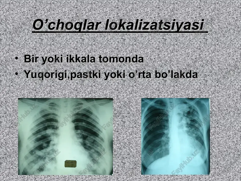 o’pkaning diffuz disseminatsiya sindromi - Page 5