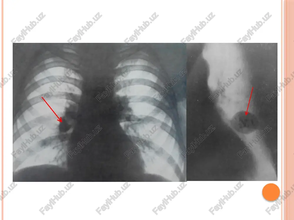 o’pkasharsimon,halqasimonqorayishsindromirentgendiagnostikasi - Page 5