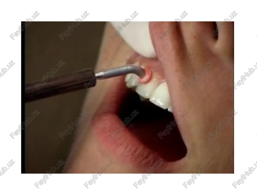 ll v diapazone ot –1 do –2,5 slujit povodom dlya diagnoza «osteopeniya» — nizkaya mineralnaya plotnost. menee –2,5 — eto osteoporoz s visokim riskom perelomov. z-ball — eto rezultat sravneniya plotnosti kostnoy massi patsienta so srednim pokazatelem ego vozrastnoy gruppi. pri slishkom visokom ili nizkom z-balle obichno naznachayutsya dopolnitelnie meditsinskie obsledovaniya: rentgenografiya, bioximicheskoe issledovanie ili biopsiya kostnoy tkani. elektrodontometriya elektroodontodiagnostika (eod) elektroodontometriya (ili eom, kak ee nazivayut stomatologi) pozvolyaet otsenit sostoyanie vnutrennix tkaney zuba i opredelit ix jiznesposobnost. dlya provedeniya protseduri ispolzuetsya elektricheskiy tok. otsenka pri pomoshi dannoy metodiki rekomenduetsya pri nalichii sereznix povrejdeniy organa, nalichii vospalitelnix protsessov i patologiy chelyustnogo otdela, a takje diagnostirovanii novoobrazovaniy. printsip raboti v osnove metodiki lejit biologicheskaya reaktsiya nervnix retseptorov zubnix tkaney na vozbujdayushiy vneshniy razdrajitel, kotorim yavlyaetsya elektricheskiy tok. funktsionalnoe sostoyanie otdelnix uchastkov opredelyaet stepen vozbudimosti. pri etom initsiiruemoe razdrajenie ne nanosit usherba fizicheskomu sostoyaniyu pulpi, ne vizivaet negativnix posledstviy i mojet primenyatsya …