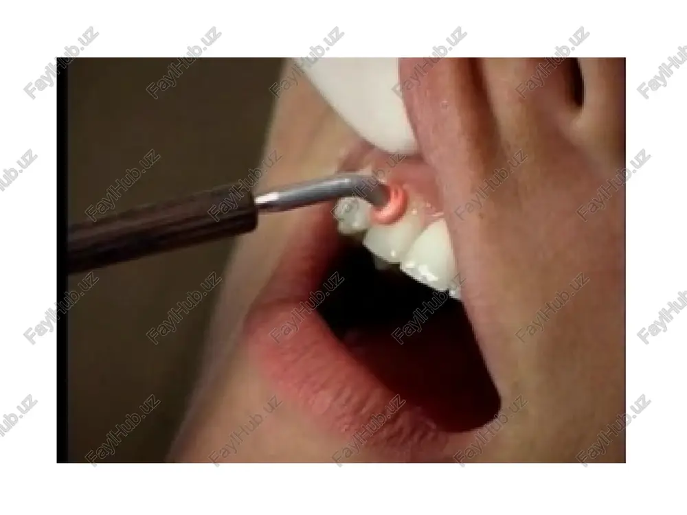 ll v diapazone ot –1 do –2,5 slujit povodom dlya diagnoza «osteopeniya» — nizkaya mineralnaya plotnost. menee –2,5 — eto osteoporoz s visokim riskom perelomov. z-ball — eto rezultat sravneniya plotnosti kostnoy massi patsienta so srednim pokazatelem ego vozrastnoy gruppi. pri slishkom visokom ili nizkom z-balle obichno naznachayutsya dopolnitelnie meditsinskie obsledovaniya: rentgenografiya, bioximicheskoe issledovanie ili biopsiya kostnoy tkani. elektrodontometriya elektroodontodiagnostika (eod) elektroodontometriya (ili eom, kak ee nazivayut stomatologi) pozvolyaet otsenit sostoyanie vnutrennix tkaney zuba i opredelit ix jiznesposobnost. dlya provedeniya protseduri ispolzuetsya elektricheskiy tok. otsenka pri pomoshi dannoy metodiki rekomenduetsya pri nalichii sereznix povrejdeniy organa, nalichii vospalitelnix protsessov i patologiy chelyustnogo otdela, a takje diagnostirovanii novoobrazovaniy. printsip raboti v osnove metodiki lejit biologicheskaya reaktsiya nervnix retseptorov zubnix tkaney na vozbujdayushiy vneshniy razdrajitel, kotorim yavlyaetsya elektricheskiy tok. funktsionalnoe sostoyanie otdelnix uchastkov opredelyaet stepen vozbudimosti. pri etom initsiiruemoe razdrajenie ne nanosit usherba fizicheskomu sostoyaniyu pulpi, ne vizivaet negativnix posledstviy i mojet primenyatsya …