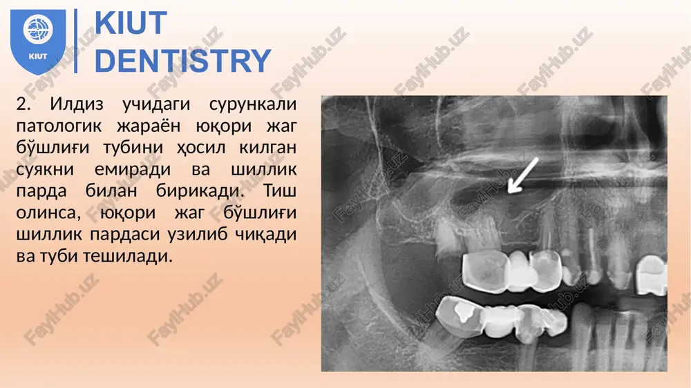 odontogensinuzitning asoratlari - Page 5