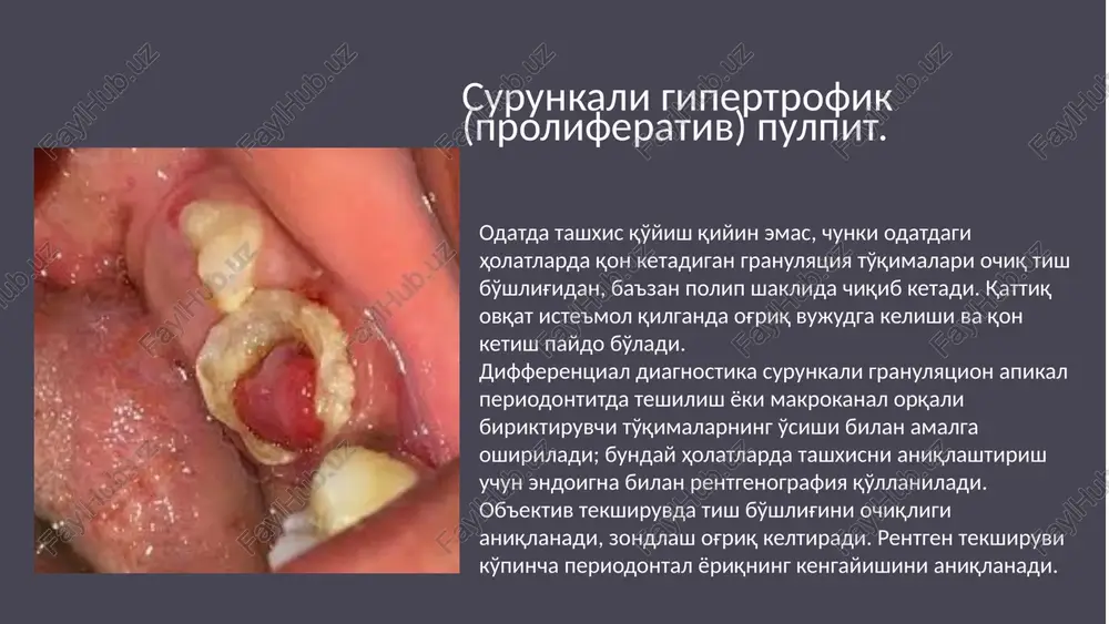 ketmaydi; tish sovuqdan ko'ra issiqqa, surunkali fibroz pulpitda esa sovuqqa ko'proq ta'sir qiladi; surunkali gangrenoz pulpitda eod ko'rsatkichi — 60—100 mka, surunkali fibroz pulpitda — 35—40 mka. 15 surunkali pulpitning rivojlanish bosqichlari surunkali pulpit asta-sekin rivojlanib, bir necha bosqichlardan o'tadi. 1 yuza pulpit pulpaning boshlang'ich yallig'lanishi, uni qaytarish mumkin. 2 surunkali fibroz pulpit normal to'qimalarni almashtiradigan fibroz to'qimalarning shakllanishi bilan pulpa yallig'lanishi. 3 surunkali gangrenoz pulpit yiringli yallig'lanish shakllanishi bilan pulpa to'qimalarining o'limi. 16 surunkali pulpitni davolash: konservativ konservativ davo yallig'lanishni bartaraf etishga va pulpaning hayotiyligini saqlashga qaratilgan. medikamentoz davolov yallig'lanishga qarshi dorilar va antibiotiklar. plombalash karioz bo'shliqlarni bartaraf qilish, tishni plombalash. 17 surunkali pulpitni davolash: endodontik konservativ usullar samarasiz bo'lsa, surunkali pulpit uchun endodontik davolash yoki ildiz kanalini davolash zarur. kanallarni tozalash yallig'langan va nekrotik to'qimalarni olib tashlash. kanallarni plombalash qayta infektsiyani oldini olish uchun kanallarni to'ldiruvchi material bilan to'ldirish. tishning restavratsiyasi tishning anatomik shaklini toj yoki plomba bilan …
