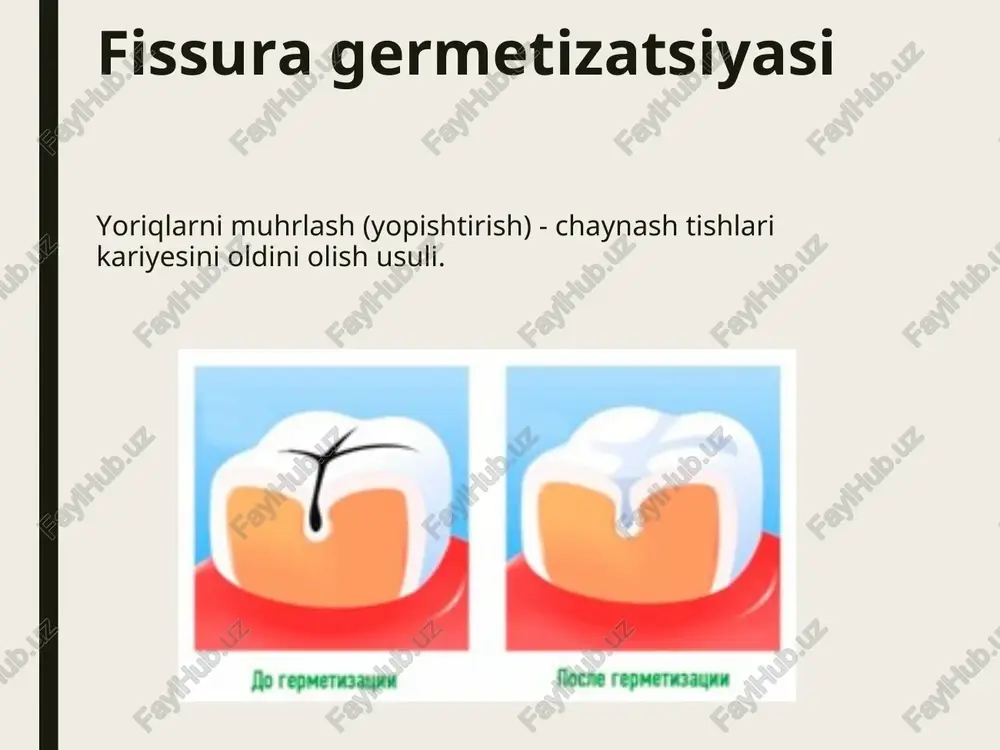 ma'ruza-14.tish qattiq to'qimalarining rezistentligini oshirish usullari - Page 5