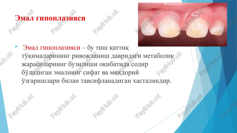 poplaziyasida egatchalar bir xil davrda rivojlanib oxaklashadigan tishlarda yoki barcha tishlarda kuzatiladi. rentgen tasvirlarda egatchalar tubi soxasida gorizontal yo'nalgan qora yo'llar, shular fonida ko'rinadigan qora dog'lar almashinuv jarayonining chuqur buzilganidan darak beradi. bu esa o'z navbatida xomilador ona, yoki yangi tug'ilgan bola boshidan kechirgan kasallikning og'irlik darajasi bilan bog'liqdir. tizimli gipoplaziya, to'lqinsimon, egatsimon shakli va emalning qisman mavjud emasligi. tizimli gipoplaziya, to'lqinsimon va egatsimon shakllariningbirga uchrashi. tizimli gipoplaziya, emalning qisman yo'qligi sistemali gipoplaziya, emalni qisman etishmasligi sistemali emal gipoplaziyasining likopchali shakli. bunday nuqsonli xastaliklarda bir davrda rivojlanib mineral tuzlarga to'yinadigan, shakllanadigan tishlarning kesuvchi va chaynov yuzalariga parallel, asosan vestibulyar va lunj satxlarida likopchasimon chuqurliklar aniqlanadi. nuqson likopcha shaklida bo'lib 1 dan 4tagacha devori mavjud bo'ladi. ba'zan likopcha bo'shlig'ini emal parda ikkiga bo'lib, ajratib turishi xam mumkin. bunda emal to'qimasining yupqalashuvi faqat nuqsonli soxada, likopchalar tubidagina emas fissuralar soxasida xam sodir bo'ladi. ba'zi likopchalar tubida emal xaddan tashqari yupqalashgan yoki bo'lmasligi …