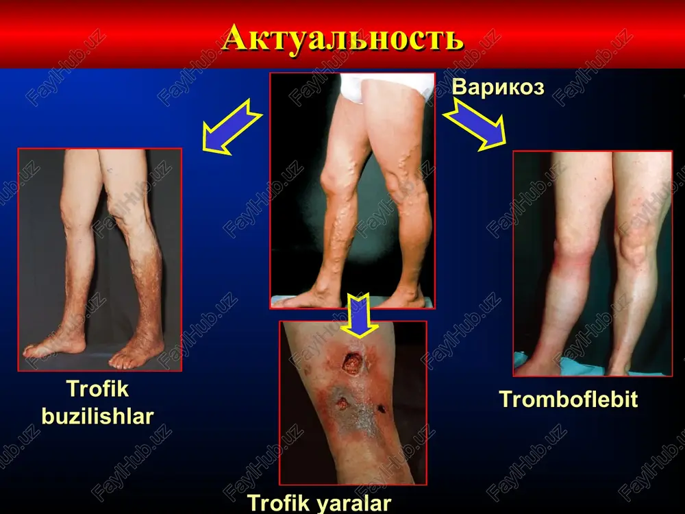 hastiya v nalojenii bandaja ili v obuchenii patsienta uchastie vracha ogranicheno podborom klassa kompressii i vida izdeliya trudnosti s obespecheniem kompressii i fiksatsii na bedre obespechivaet effektivnuyu kompressiyu i fiksatsiyu na bedre primenyayutsya pri nestandartnoy forme konechnosti pri nestandartnoy forme konechnosti vozmojno izgotovlenie na zakaz ejednevnaya stirka privodit k bistromu iznosu bintov ejednevnaya stirka neobxodima dlya soxraneniya kompressionnix svoystv neobxodimost zameni posle neskolkix stirok garantiya soxraneniya kompressionnix svoystv v techenii 6 mesyatsev vozmojni narusheniya vodnogo i temperaturnogo balansa koji poristaya vyazka obespechivaet normalniy temperaturniy i vodniy balans koji nizkie esteticheskie svoystva, ne obespechivayut udobstvo i komfort visokie esteticheskie svoystva, udobstvo i komfort pri ispolzovanii surunkali venoz etishmovchilikning og'irligiga qarab konservativ davo algoritmi razrabotan rabochey gruppoy assotsiatsii flebologov rossii v sostave professorov kirienko a.i., bogacheva v.yu., koshkina v.m. s klinika rekomenduemie sposobi lecheniya 0 otsutstvie simptomov pri osmotre i palpatsii elasticheskaya kompressiya 1 teleangioektazii ili retikulyarniy varikoz elasticheskaya kompressiya, fleboprotektor 2 …