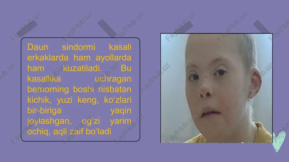daun sindromli - Page 5