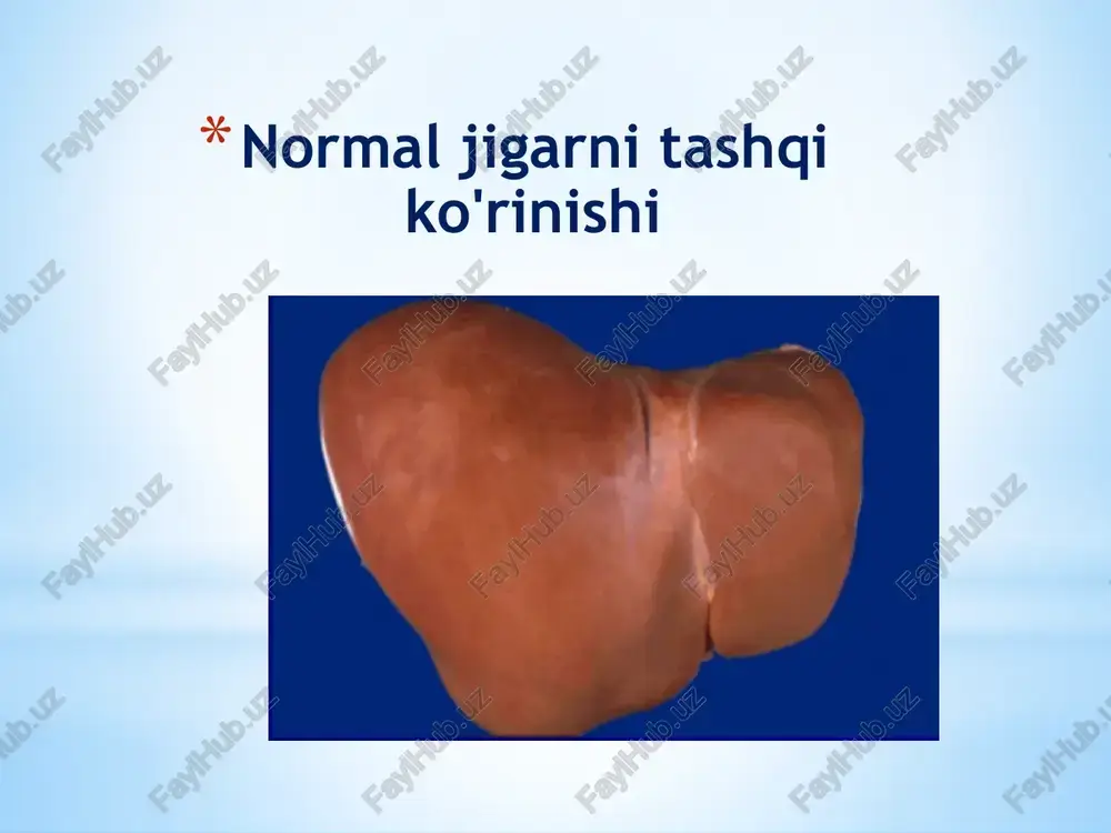 ilirubini peshob najas fermentlar holati sifati miqdori biliru-bin urobilin sterkobi lin act. alt. meyorda noto’g’ri 8,55-20,52 mkmol (8,8-1,2 mg%) +- (izlar) ++ 0,1-0,4 mmol gemolitik sariqlik noto’g’ri > — ++ +++ n mexanik sariqlik to’g’ri noto’g’ri > + — — — n yoki biroz oshgan parenximatoz sariqlik to’g’ri > ++ +boshi - qasal. chuxisid + sogaish - qasal. chukkisi +sogaish oshgan obrazets teksta vtoroy uroven tretiy uroven chetvertiy uroven pyatiy uroven jigar sirrozi jigar sirrozi jigar sirrozi – surunkali kasallik bo'lib, bunda diffuz ravishda biriktiruvchi to’qima o’sishi kuzatiladi. natijada jigar strukturasi buziladi va a'zoning qayta tuzilishi kuzatiladi ( soxta jigar bo'laklari shakllanadi). sirroz iborasi 1819 laennek tomonidan kiritilgan (jigarning tashqi ko’rinishi asos qilib olingan: qattiq konsistentsiya, bo’lakchali, malla rangda). etiologiyasi etiologiyasiga ko’ra: infeksion; toksik; toksiko-allergik; biliar; almashinuv alimentar; sirkulyator; kriptogen. jigar sirrozi keng tarqalganlari – virusli, alkogolli va billiar jigar sirrozlaridir. virusli sirroz gepatit b va ayniqsa gepatit c dan …