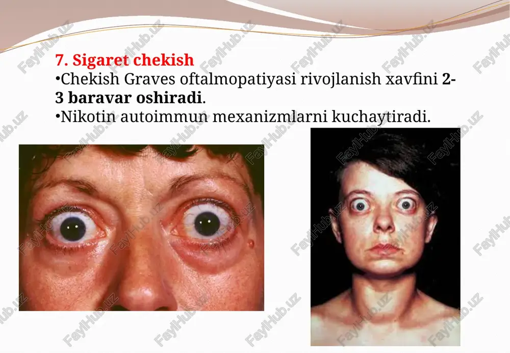 li bo‘lib, tashxis qo‘yish uchun klinik, laborator va instrumental tekshiruvlar majmuasi zarur. quyida dtb tashxislashda ishlatiladigan asosiy bosqichlar keltirilgan: 1. anamnez va klinik ko‘rik shikoyatlar: ozib ketish, issiqlikka toqat qilmaslik yurak urishining tezlashuvi (taxikardiya) asabiylik, titrash (tremor) ko‘zlarda g‘alati sezgi: shish, og‘riq, ko‘rish buzilishi qalqonsimon bez sohasida kattalashish ko‘rikda: qalqonsimon bez — diffuz kattalashgan, yumshoq, og‘riqsiz teri nam, iliq, oftalmopatiya mavjud (ekzoftalm) yurak urish ritmi tezlashgan (100–140 bpm) barmoqlarda nozik tremor ayrim holatlarda — pretibial miksedema 2. laborator tahlillar tahlil nomi kutilyotgan natijalar (dtb uchun xos) tsh (tirotropin) past (gormonlar ko‘pligi gipofizni to‘xtatadi) ft4 (erkin tiroksin) yuqori ft3 (erkin triyodtironin) yuqori (ba’zan ft4 dan ham ko‘proq oshgan bo‘ladi – t3 tireotoksikoz) tsh-reseptorlariga qarshi antitanachalar (trab) musbat (asosiy marker) at-tpo, at-tg ba’zida musbat bo‘ladi, ammo spesifik emas trab mavjudligi — basedov kasalligiga differensial tashxisda hal qiluvchi rol o‘ynaydi. 3. instrumental diagnostika qalqonsimon bez utt (uzi): ko‘rsatkich natijalar hajmi ⬆ kattalashgan (diffuz) …