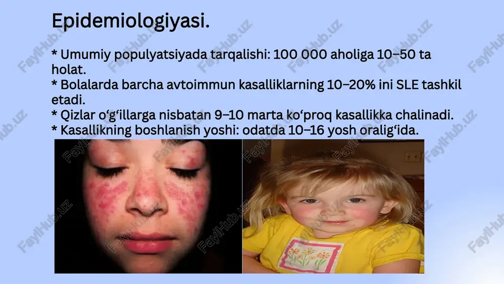 sistemali qizil volchanka uchun juda xos belgi bo‘lib, lyupus karditda miokard va endokard zararlanadi. miokardit o‘choqli yoki yalpi bo‘ladi. bemor yurak urishi, hansirashdan shikoyat qiladi. pankardit — yurak barcha qavatlarining birdaniga zararlanishi deyarli uchramaydi. perikardit va notipik so‘galsimon libman-saks endokarditi exokardiografiyada aniqlanishi mumkin. quruq perikarditda to‘sh suyagidan chaproqda 3-4-qovurg‘a oralig‘ida perikard ishqalanish shovqini eshitiladi. libman-saks endokarditi uchun yurak cho‘qqisida dag‘al sistolik shovqin va i tonning susayishi, o‘pka arteriyasida ii ton kuchayishi xarakterlidir. volchanka endokarditi yurak illati — mitral qopqoqlar yetishmovchiligiga olib keladi. reyno belgisi sistemali qizil volchankaning boshlang‘ich davridayoq ko‘rinadi, bu tomirlarning tizim yallig‘lanishi natijasidir. bu kasallikda qo‘l sovishi, oqarib, ko‘kimtir tus olishi, uvishishi, barmoqlar qorayib, nekrozga uchrashi mumkin. bemorlarda glomerulonefrit rivojlanib, qon bosimining ko‘tarilishi, angiopatiyalar, miya qon tomirlarining jarohatlanishi rivojlanishi mumkin. sistemali qizil volchanka 2-4 yil davom etgach, o‘pka zararlanadi — lyupus pnevmonit. bemorlarda nafas qisishi, quruq yoki balg‘amli (baʼzan qon aralash) yo‘tal, hansirash, ko‘krak qafasida og‘riq bo‘lishi kabi …