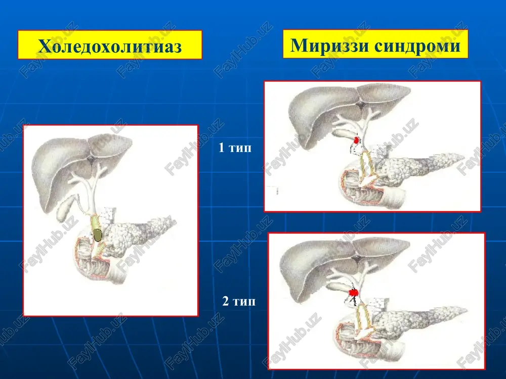 ganda, yoki unga karshi ko'rsatma bo'lganda o't yo'lini to'suvchi gepatikopankreatoduodenal sohaning o'smalari. tjxsga qarshi ko'rsatma punktsiya qilish sohasidagi o'sma pti ning 50% gacha pasayib ketishi trombotsitlar sonini 100 mingacha pasayib ketishi jigar bilan qorin devori o'rtasiga ichak qovuzlog'ini tushib qolishi punktsiya qilish sohasida yumshoq to'qimalarni yiringlashi anamnezda yod moddasiga bo'lgan allergik reaktsiyalar teri va jigar orkali xolangiografiya va xolangiostomiya teri jigar orqali o't yo'llarini seldinger usuli bo'yicha drenajlash tashqi drenajlash tashqi - ichki drenaj mexanik sariqlikni davolashda qo'llaniladigan jarrohlik amaliyotlar ichki transduodenal xoledoxoduodenostomiya transduodenal papillosfinkterotomiya va papillosfinktroplastika xoledoxoduodenostomiya xda yurash bo'yicha xda flerken bo'yicha xda finsterer bo'yicha xoledox strikturasida bajariladigan amaliyotlar geyneke-mikulich bo'yicha xoledox plastikasi xoledoxni rezektsiyasi «oxirini oxiriga» anastomozi bilan ru bo'yicha ichaklar aro u-simon anastomozi bilan terminolateral gepatikoenteroanastomoz “en-yonga” ichaklar aro anastomozi bilan terminolateral gepatikoenteroanastomoz xoledoxga drenaj o'rnatish usullari vishnevskiy xolsted ker pikovskiy mexanik sariqlikni tashhislash va davolashdagi yangiliklar mexanik sariqlikda jigar etishmovchiligini davolashda adenometioninni ahamiyati mexanik sariqlikni …