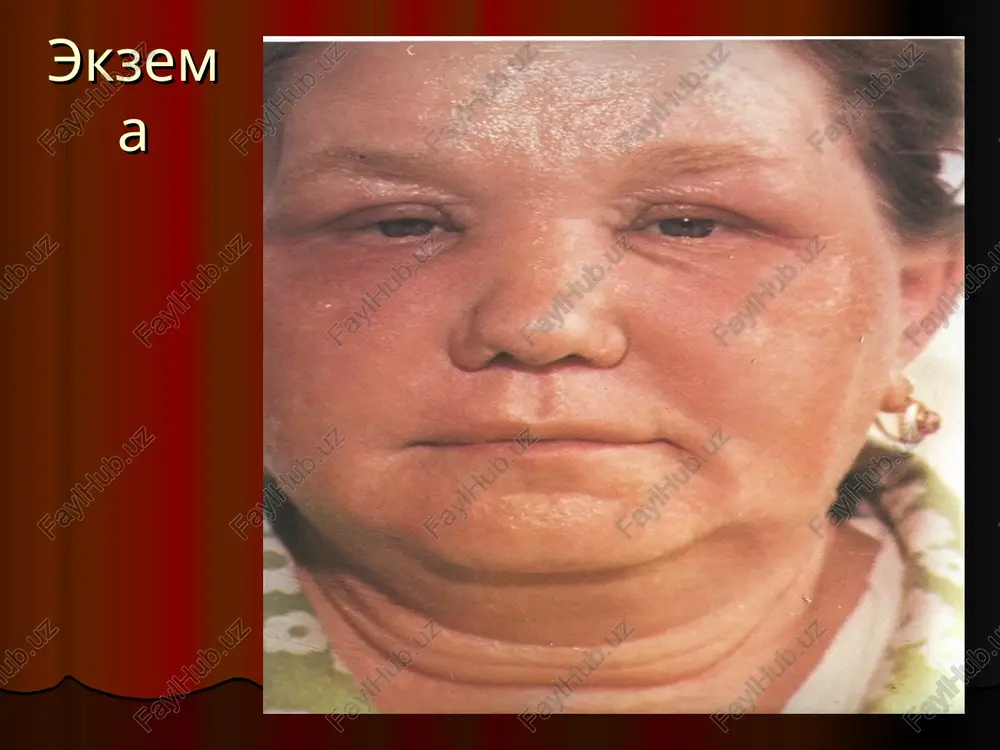 25 dan 3 marta ichgani yoki 2,5% eritmasidan 1 ml dan ukolga, yoki diazolin 0,1 tavegil 0,01 dimedrol 0,05 pipolfen, 0,25dan 2-3 marta ichgani beriladi. suv chikish va ishganni kaytirish uchun kasallik boshlanishda 3-4 kun siydik xaydovchi preparatlari – gipotiazid, furosemid beriladi. ba'zan sedativ preparatlar – brom, valerian, neyroleptik preparatlar (elenum oksiludin, amizil). agar kasallik surunkali kechsa, boshk dorilar yordam bermasa, kortikosteroid gormonlari anabolil gormonlar bilan (metandrostenalon, nerabolil, retabolil) beriladi. kerak vaktda vitaminlar kullaniladi agar utkir yalliglanish, suv chikish bulsa xar-xil eritmalar (rivanol 1-1000, 2% bornaya kislota, 0,2% furatsillin, 0,25% lyapis va x-zolar) bilan pirmochka kilinadi. suv chikish tuxtagandan keyin pasta yoki boltushkalar kullaniladi. agar kichishish bulsa pasta va boltushkalarga anestezin, naftalon nefti kushiladi. yalliglanish utib, pustloglar tushgandan keyin mazlarga utiladi, gormonlar mazlar (flutsinar, larinden, ftorokort va x-zolar), 2-10% naftalan nefti, 5-10% asd 1-2% dyogt, 2-5% sera va boshkalar. ekzemada - kompleks davoga elektroson, sedativ, antigistamin, primochkalar, bor, furatsillin malxamlari, …