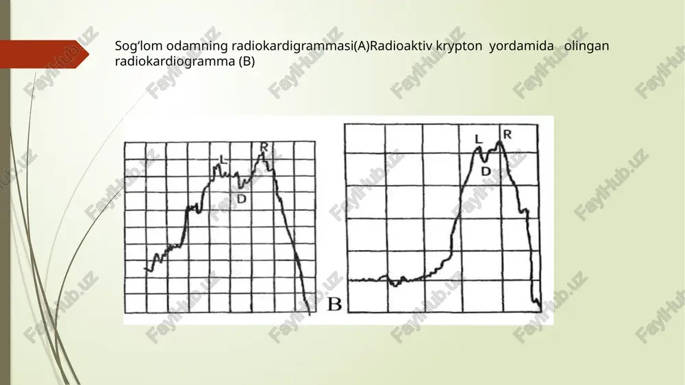 yurak ishemik kasalligi nur tashxisi - Page 5