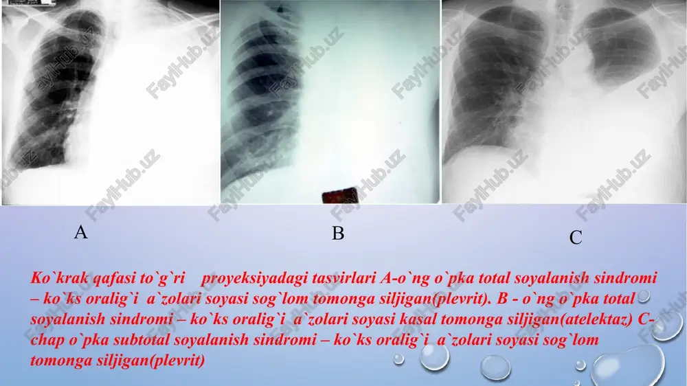 si (50%), chegarasi tekis, o’sishi sekin. bronxial adenoma. markazda ko’proq uchraydigan o’sma (asosiy bronxda). karsinoid turi (neyroendokrin karsinoma) 90% adenomalarni tashqil qiladi (xavfli o’sma). xavfsiz adenomalar deyarli uchramaydi. karsionoid ko’proq yosh bemorlarda uchraydi va chekish bilan aloqasi yo’q. klinik: qon tuflash, atipik astma, yo’tal, rekurrent pnevmoniya. belgilari: sekin o’sadi, metastaz kam beradi, 80% holatda tugunni o’zi ko’rinmaydi, bo’lak/o’pka/segment gipoventilyasisi giperventilyasiyasi va atelektazi, pnevmoniya/asbsess/bronxoektaz, yumaloq shaklda tugun (20%) o`lchami 1-10 sm, 1/3 kalsifikatlar. endokrin buzilishlar kam bo�ladi. gamartoma. gamartoma bronxial adenoma - o`pka to`qimalaridagi yallig`lanish jarayonidir. ko`p holatlarda kasallikni qo`zg`atuvchi vosita infektsiyalardir. infektsiyanining tanaga kirish yo`llari turli xil: ko`pincha havo-tomchi orqali, kam hollarda qon orqali. zotiljam rivojlanishi uchun masul bo`lgan mikroorganizmlarning bir qismi inson tanasida doimo mavjud. immunitetning muhofaza qilish darajasi me`yorda bo`lganda u bunday infektsiyalar bilan muvaffaqiyatli kurashadi, himoya kuchlari darajasining pasayishi (gipotermiya [sovqotish], birlamchi kasalliklar) bilan o`pkada yallig`lanish jarayoni rivojlanadi. ko`pincha zotiljamning etiologiyasida yuqori nafas yo`llarining kasalliklari mavjud. shamollash, …